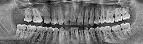 Teeth, Film, Showing, Medical X-ray, X-ray Image