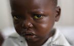 Three-year-old Jonathan Kangu sits on his hospital bed in Kinshasa, Congo, on Tuesday, July 19, 2016, suffering from symptoms of yellow fever, includi
