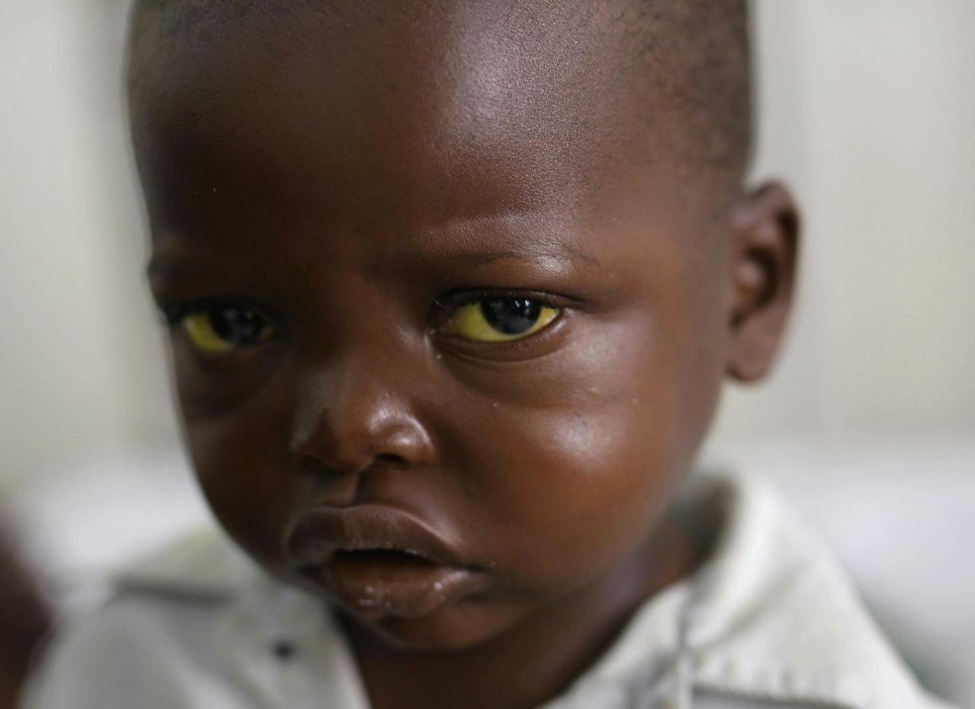 Three-year-old Jonathan Kangu sits on his hospital bed in Kinshasa, Congo, on Tuesday, July 19, 2016, suffering from symptoms of yellow fever, including yellowed eyes. Because of a shortage of diagnostic materials, doctors were not able to confirm whether or not he has yellow fever, as the symptoms are similar to those for many other diseases in the region. Jonathan ultimately recovered and was discharged, but without knowing for sure whether he had yellow fever, it was unclear if his family sho