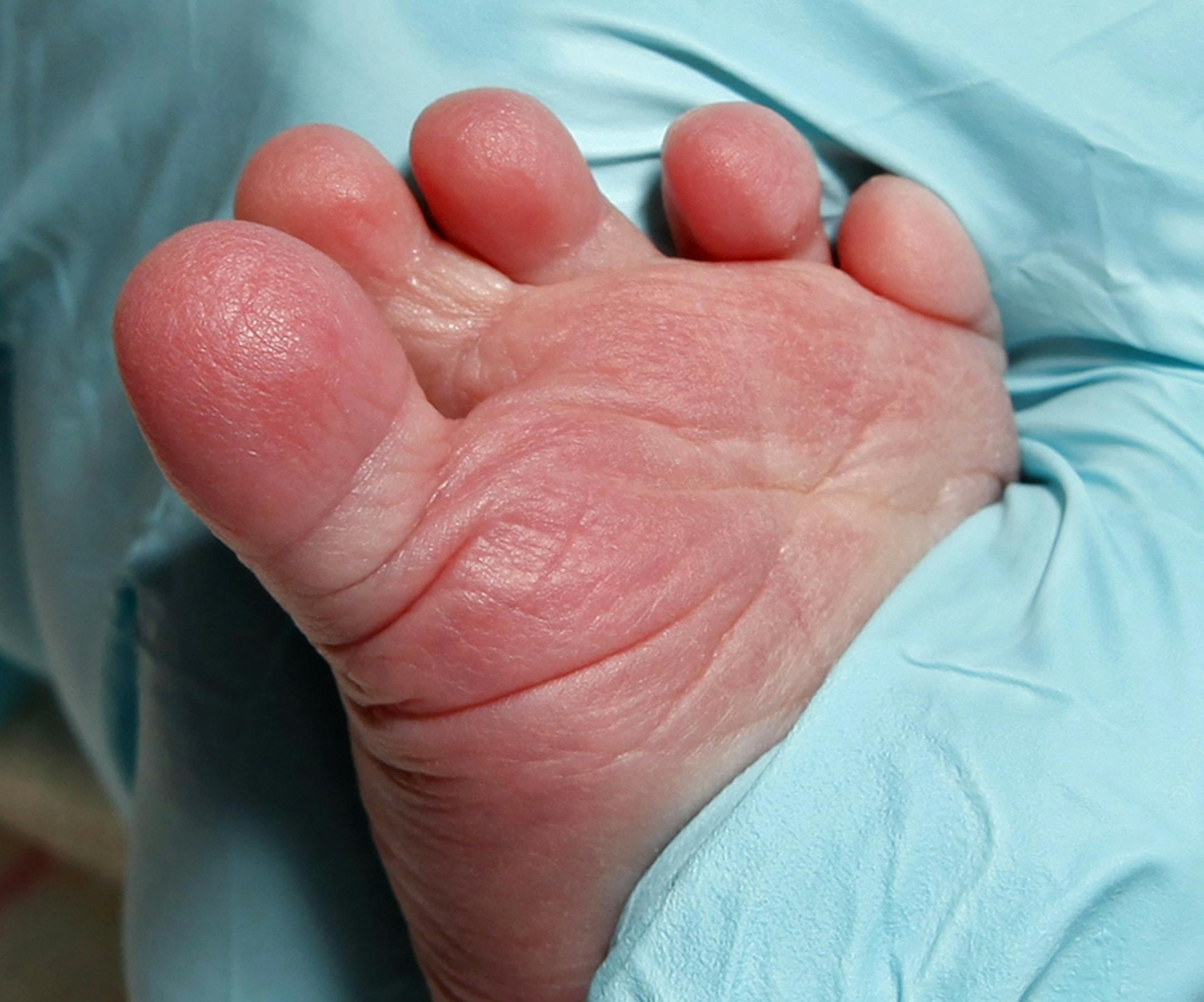A one-day-old baby boy's heel is pricked for blood during a phenylketonuria (PKU) test at Washington Hospital Center in Washington, Friday, Feb. 5, 2010. A critical safety net for babies _ that heelprick of blood taken from every newborn _ is facing an ethics attack. States increasingly are storing the leftover blood samples for later medical research, often without parents' knowledge or consent _ prompting lawsuits in two states and work in many others to give parents a greater say. (AP Photo/J
