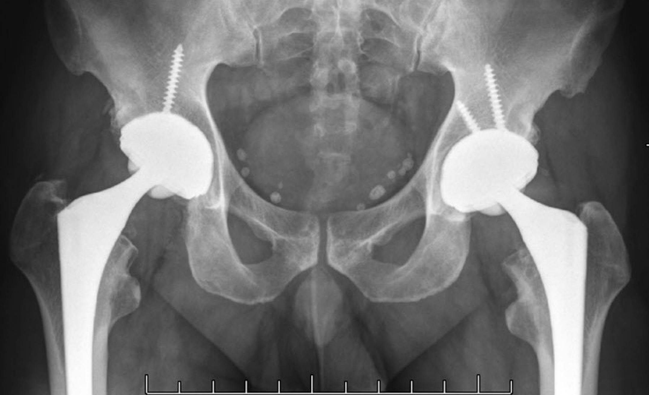 These are before and after pictures of Jay Alva who had double hip implants. He was very happy with the procedure. ]richard tsong-taatarii/rtsong-taataarii@startribune.com