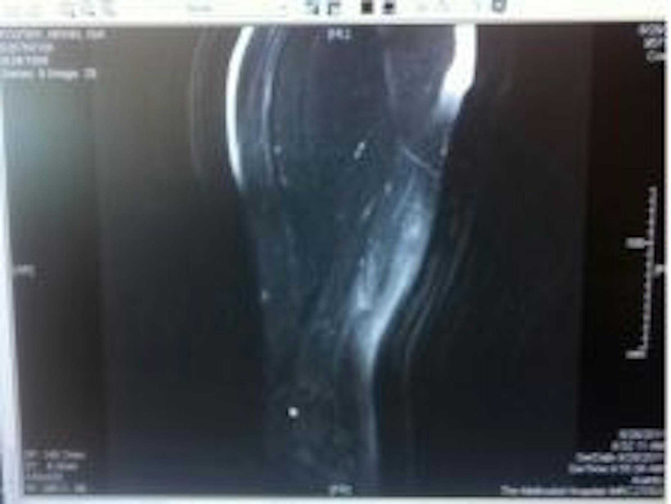 Arian Foster's hamstring MRI, via Twitter