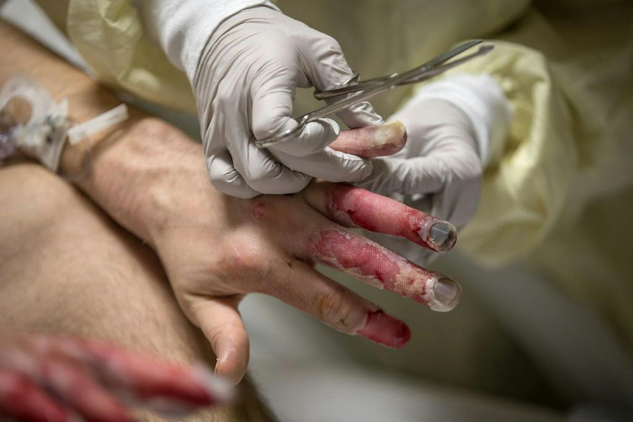 Hennepin County Medical Center burn unit's Sarah Blake addressed frost bite wounds on a patient, Wednesday, January 10, 2018 in Minneapolis, MN.