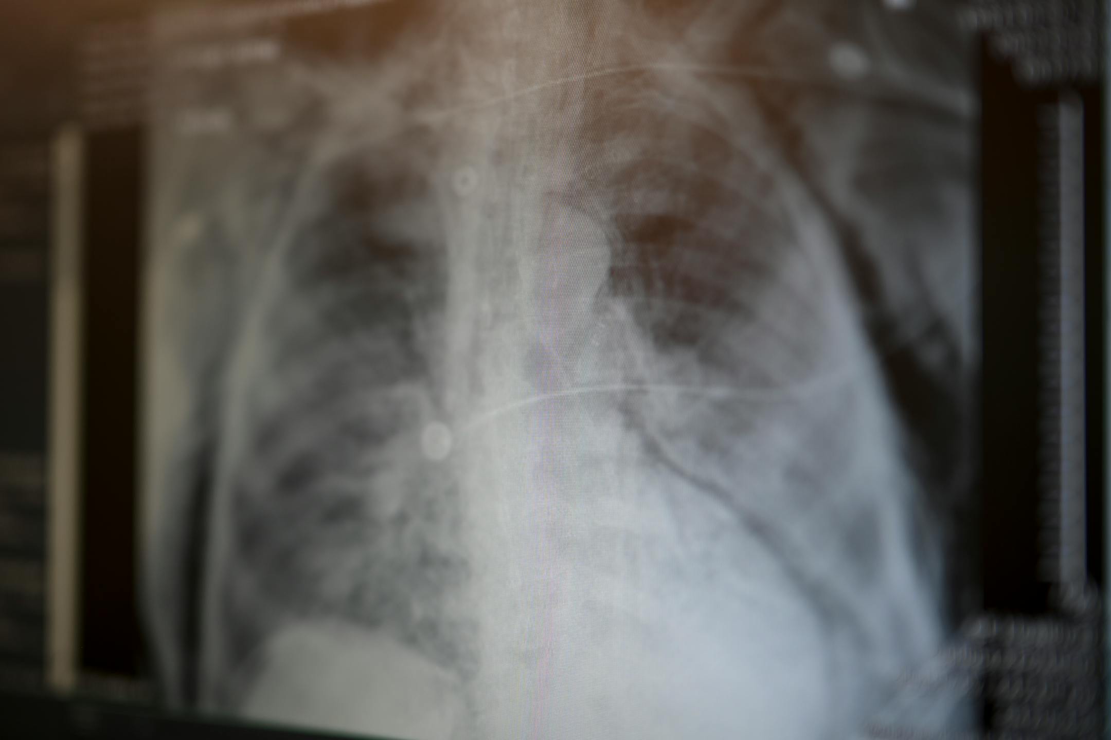 An X-Ray shows the subcutaneous air escaping from a critically ill COVID patient's lungs Tuesday, Feb. 8, 2022 at North Memorial Health Hospital's South 7 Intensive Care Unit in Robbinsdale, Minn.
