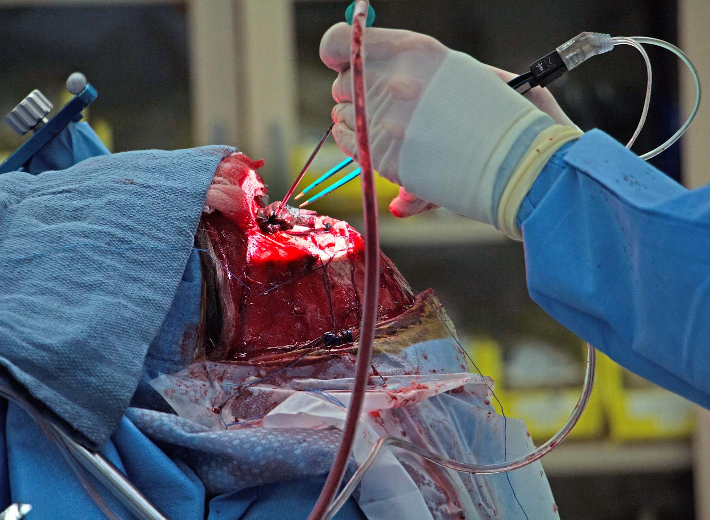 1213: Dr. Dino Terzic, senior neurosurgery resident at the University of Minnesota, removes a possibly cancerous brain tumor from a patient under the supervision of Dr. Matthew Hunt, director of the residency program. &#x201a;&#xc4;&#xfa;It&#x201a;&#xc4;&#xf4;s up to the pathologists now,&#x201a;&#xc4;&#xf9; Hunt said, praising Terzic&#x201a;&#xc4;&#xf4;s work. Photo: Dan Browning/Star Tribune