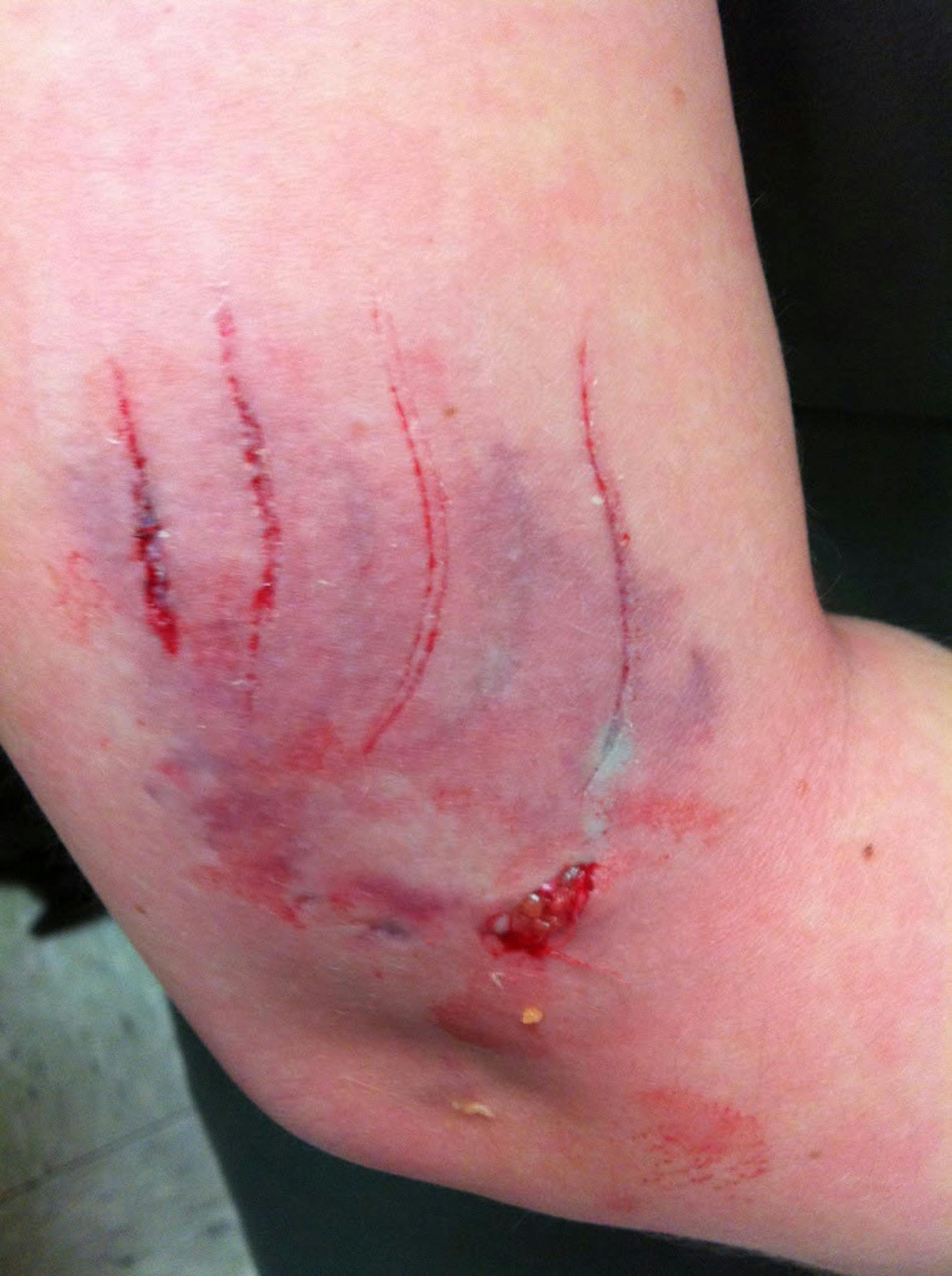 During his two years at a veterinary clinic, Brody inflicted three more bites, including this one on a staffer's elbow.