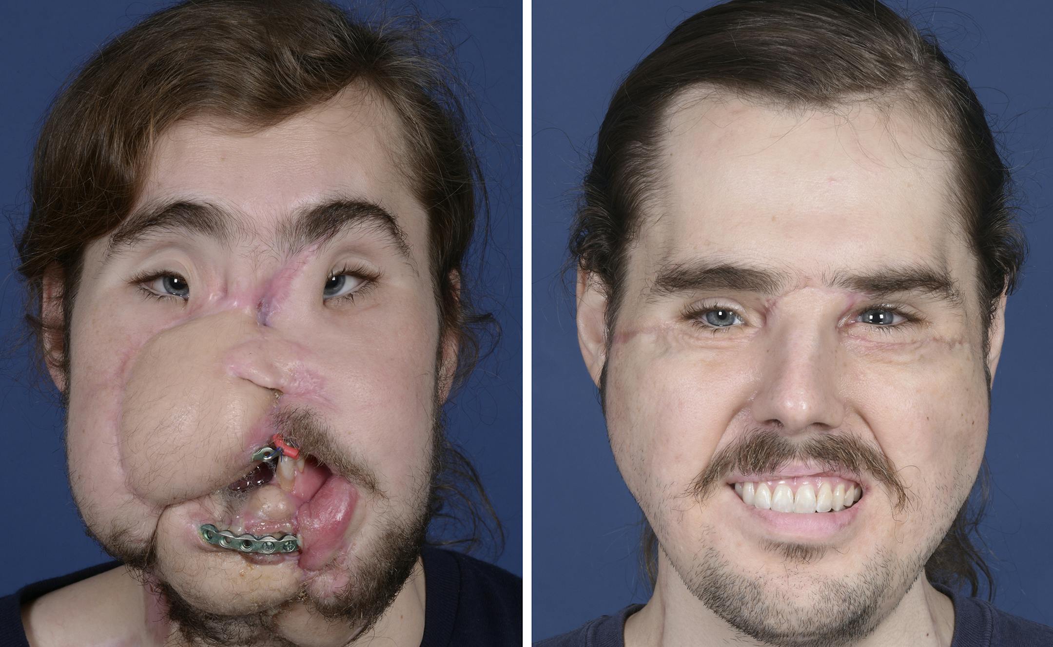 These photos provided by NYU Langone Health, show patient Cameron Underwood, left, on March 15, 2017, and right, on Oct. 17, 2018, following his face transplant. The northern California man whose suicide attempt left his face horribly disfigured had successful facial transplant surgery in early 2018. (Mary Spano/NYU Langone Health via AP)