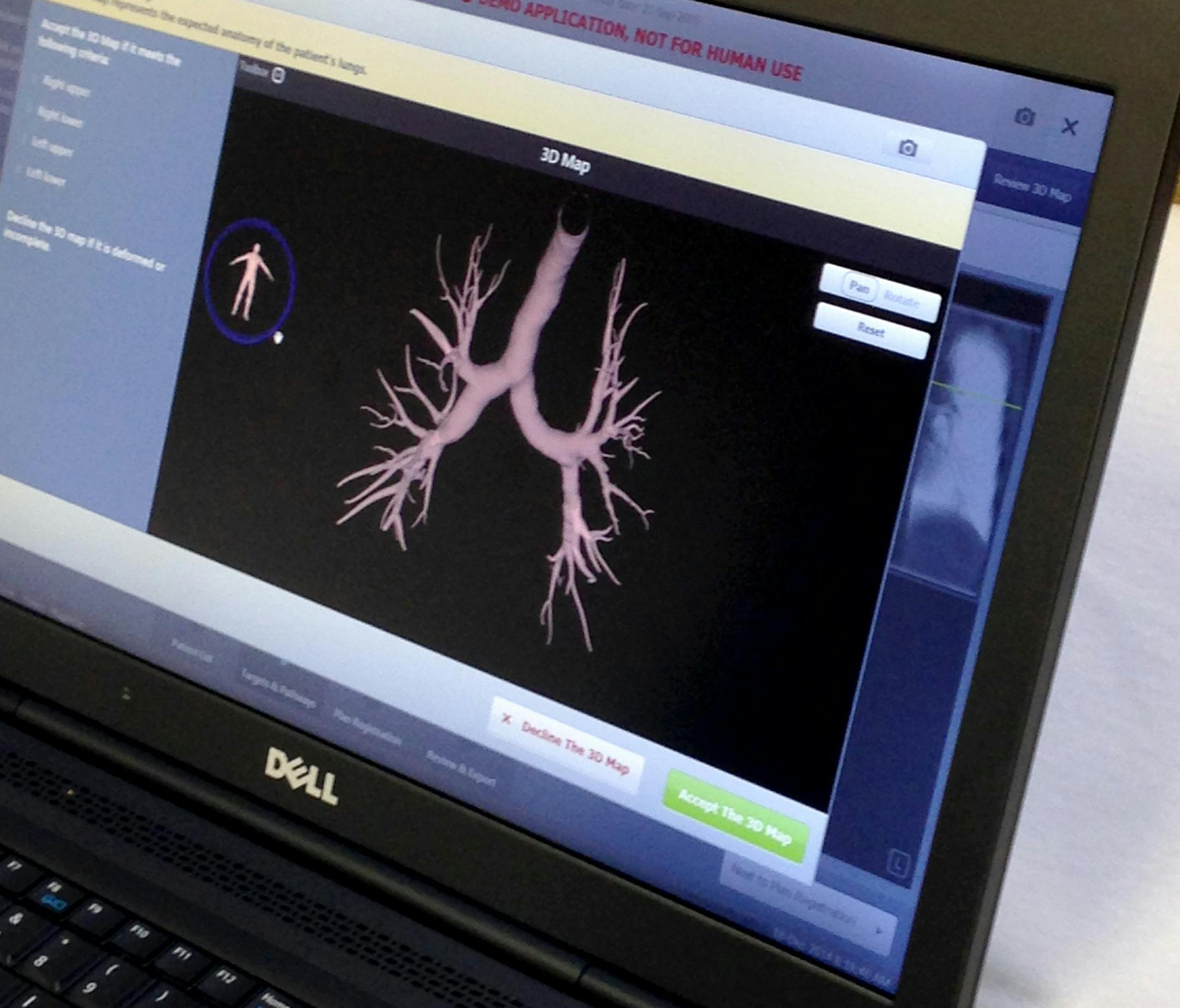 SuperD virtual bronchoscopy -device made by a Plymouth company called SuperDimension. The device is used to guide a probe deep inside the lung to take a tissue sample for cancer biopsy. The virtual bronchroscopy is done before the procedure to map a path for the lung probe.