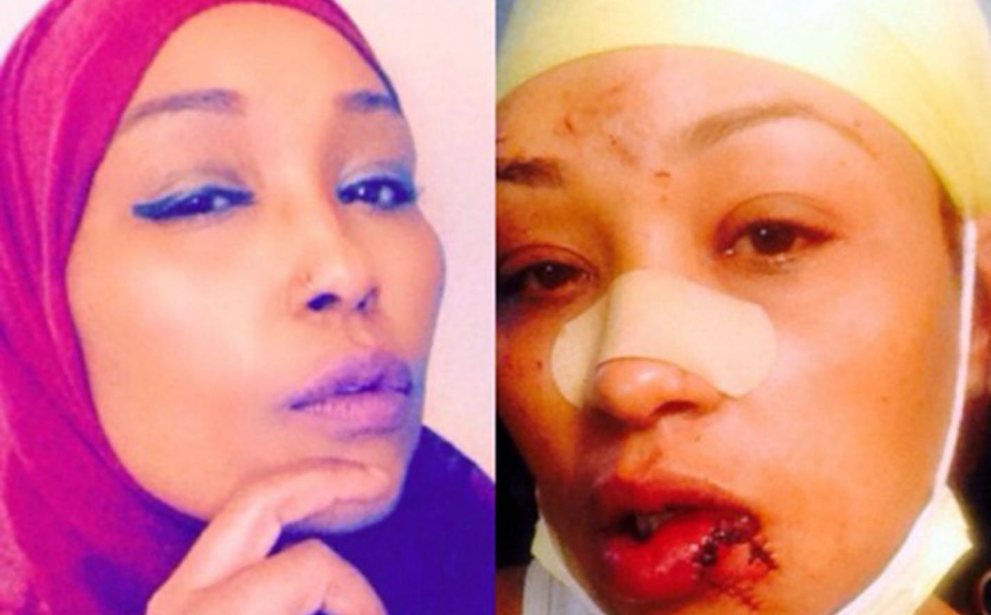 The Anoka County attorney&#xed;s office said Thursday that a felony assault charge will stand against the woman who allegedly attacked a diner at the Coon Rapids Applebee&#xed;s for speaking Swahili. The victim, Asma Jama, suffered deep cuts to her face when she was assaulted Oct. 30 with a beer mug as she ate lunch, Anoka County authorities said. Jodie Burchard-Risch, 43, of Ramsey, was charged in Anoka County District Court with third-degree assault. CAIR provided these photos of the victim, i