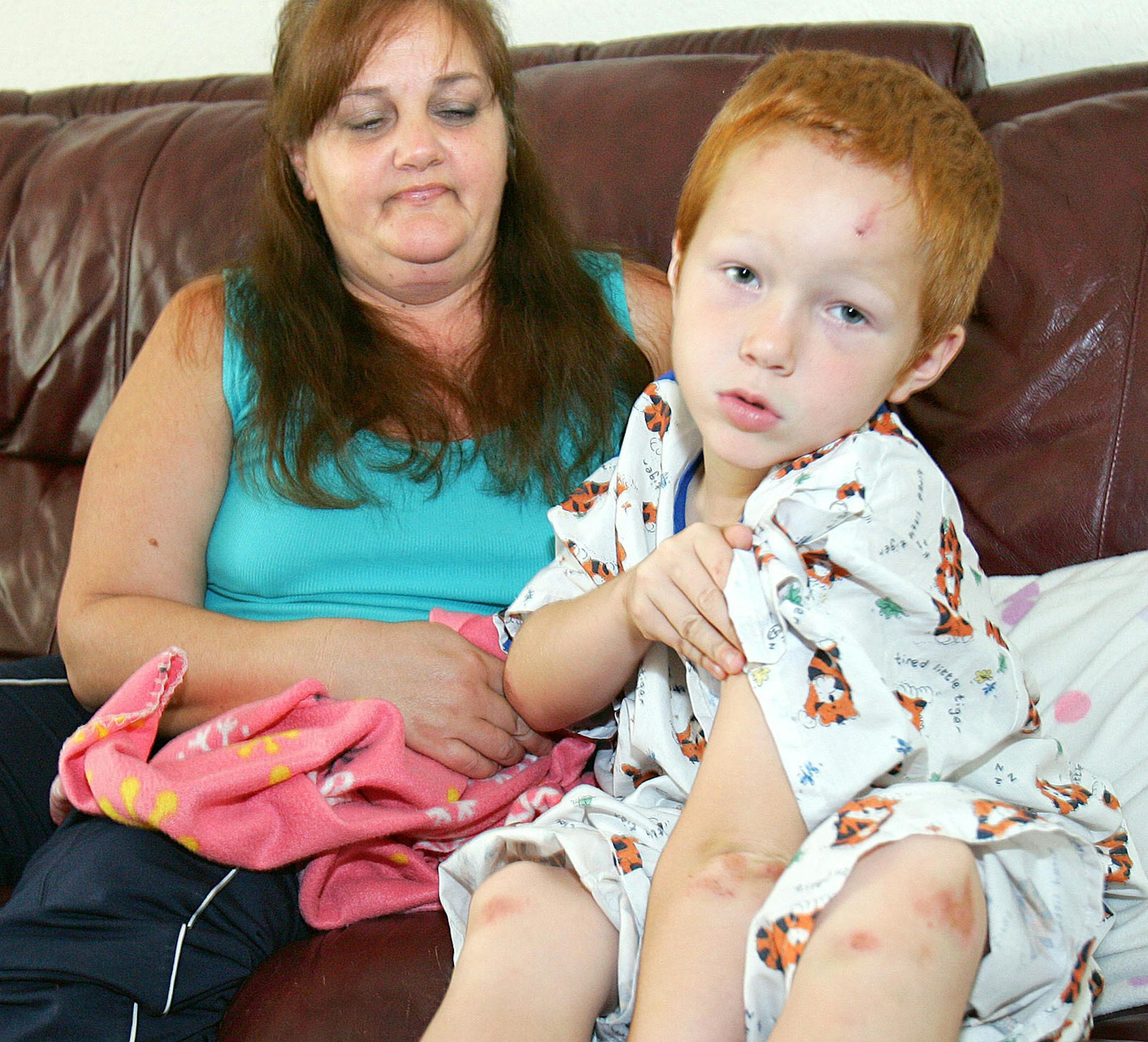 Kenny Markiewicz, 8, with his mother, Amber Markiewicz shows some of the bruises he suffered Wednesday,when he was swept through six blocks of storm sewer in Duluth, Minn.,Thursday, June 21, 2012. Duluth officials say it's still not safe for evacuated residents to return to their homes in the low-lying Fond du Lac area. (AP Photo/The Duluth News-Tribune, Steve Kuchera)