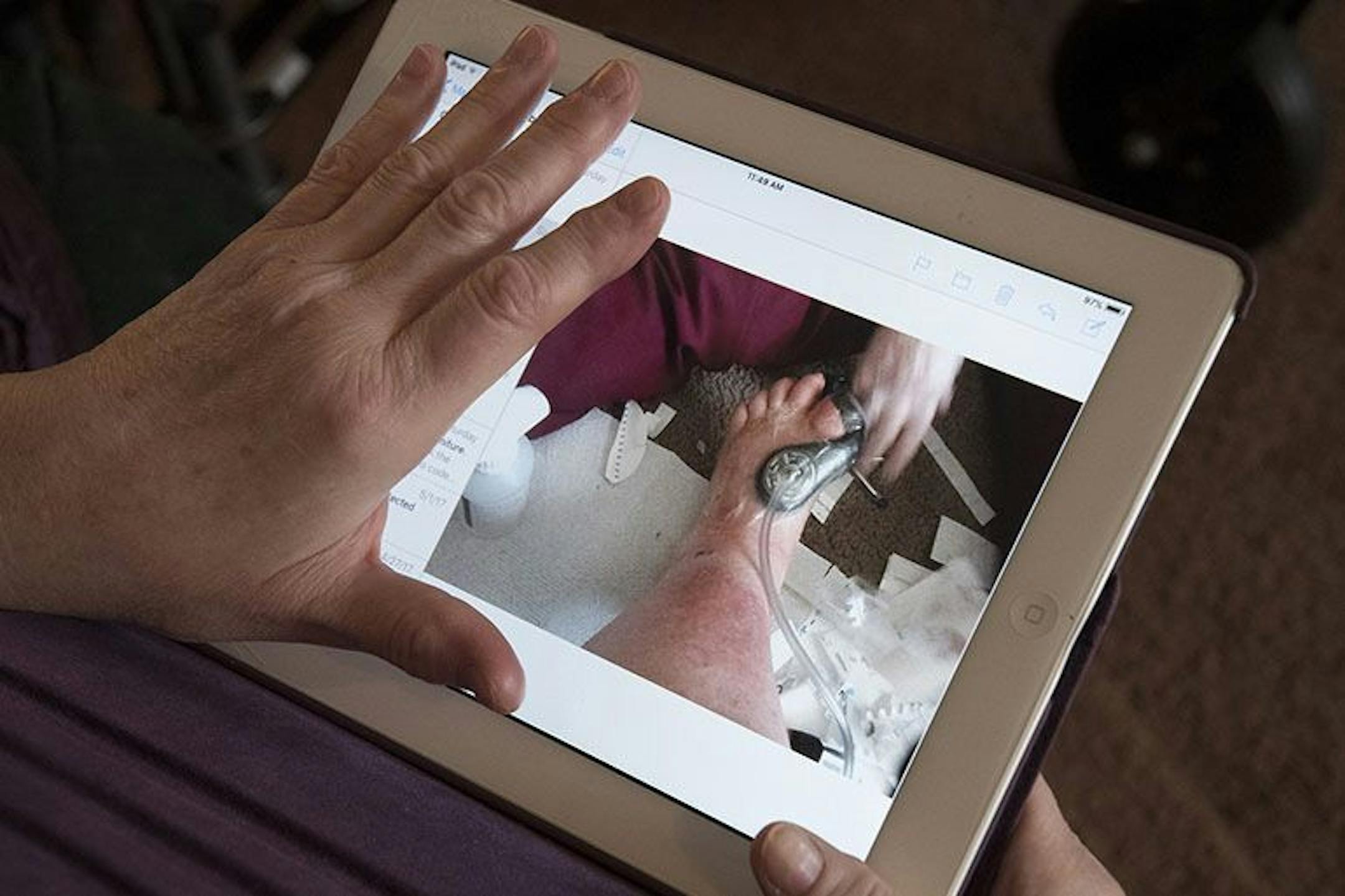 Carol Emanuele of Philadelphia shows a photograph of a wound VAC (vacuum-assisted closure) procedure on her left foot after the amputation of her big toe.