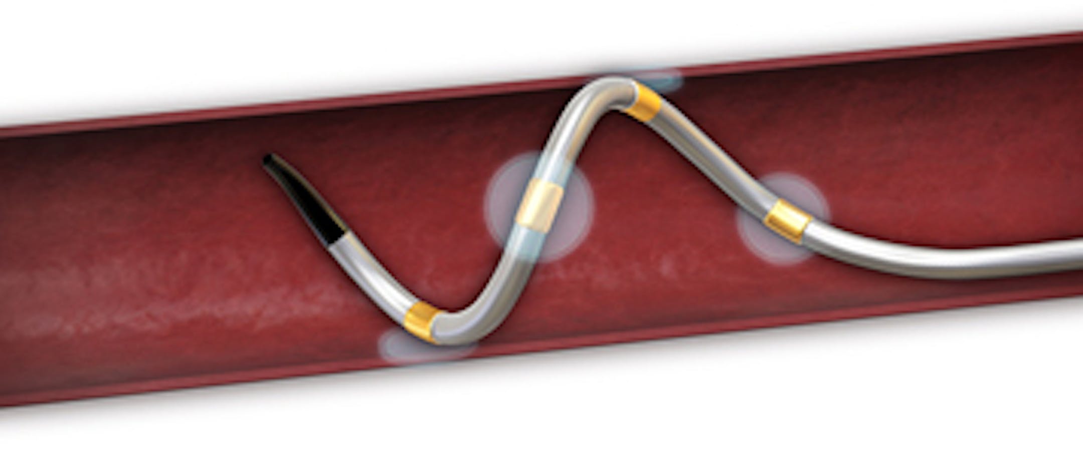 Spyral device shown in the blood vessel