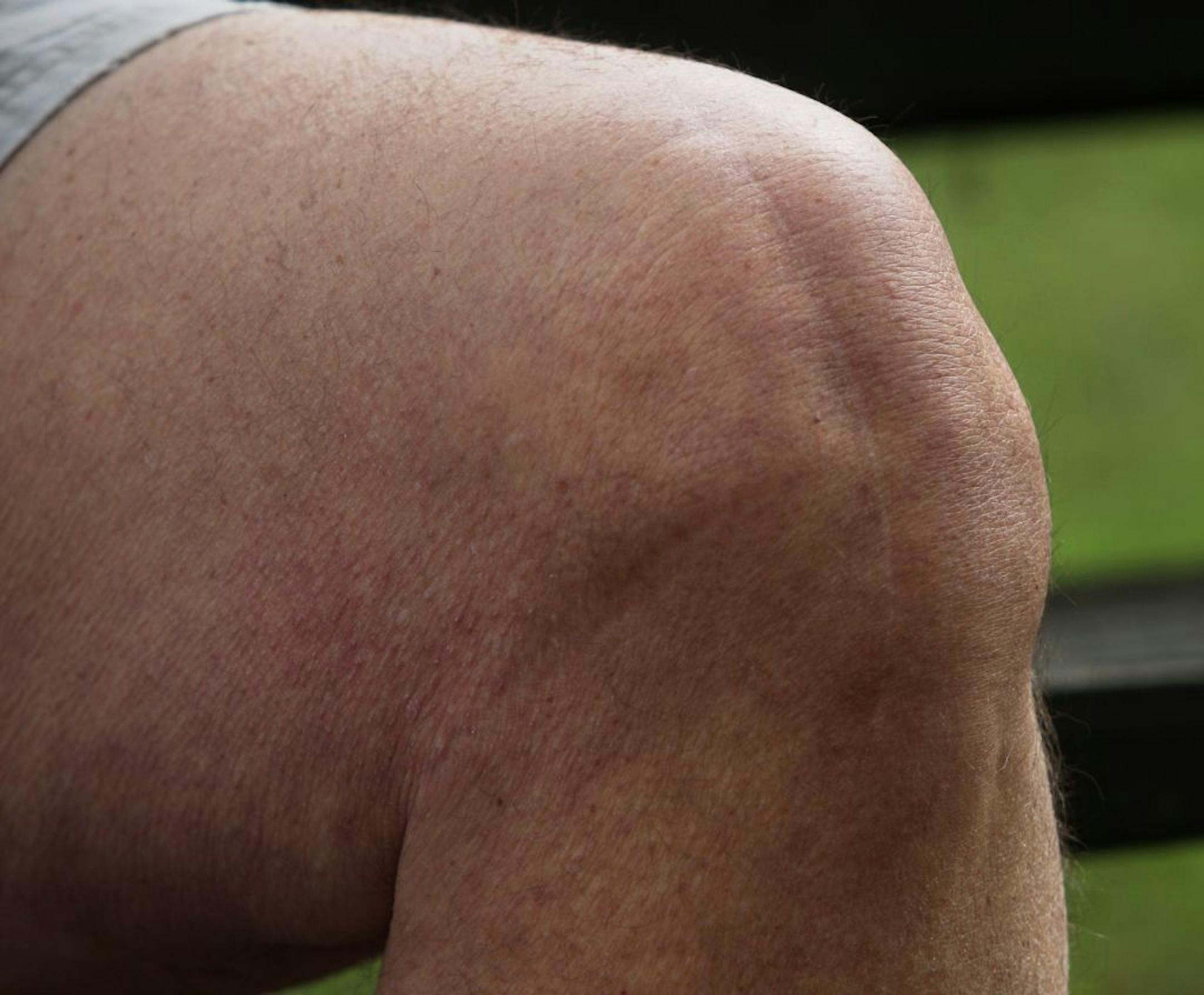 Jeff Robinson had both knees replaced, now can walk, and play golf. March 17, 2012.