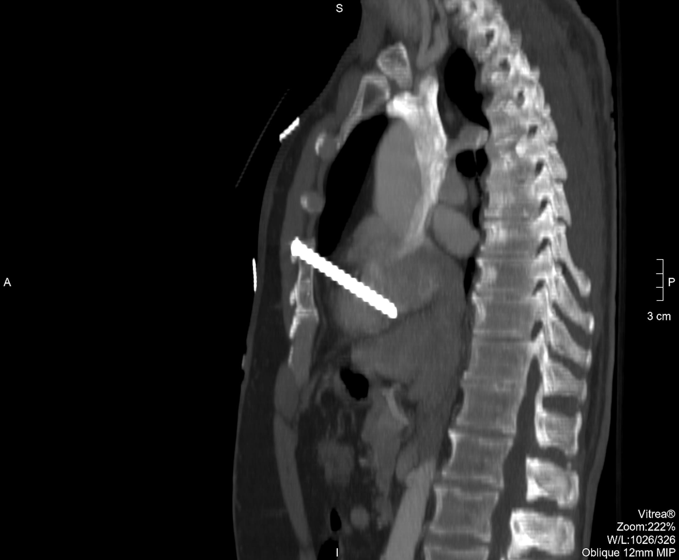 X-ray of nail in heart from Abbott Northwestern Hospital.
