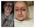 Autumn Larson says she suffered these injuries after being hit by a police projectile during the protests over George Floyd’s killing.