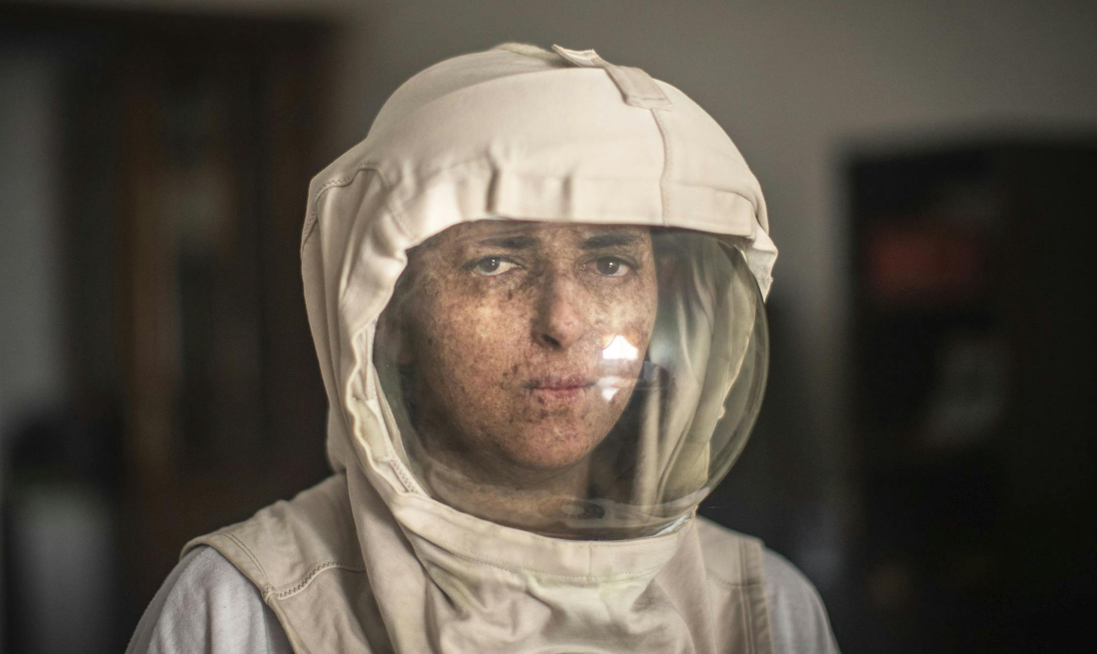 In this Tuesday, July 16, 2019 photo, Fatimazehra El Ghazaoui, 27, a woman affected by a rare disorder called xeroderma pigmentosum, or XP, poses for a portrait wearing a protective mask she wears outside on sunny days, in her home in Mohammedia, near Casablanca, Morocco. (AP Photo/Mosa'ab Elshamy)