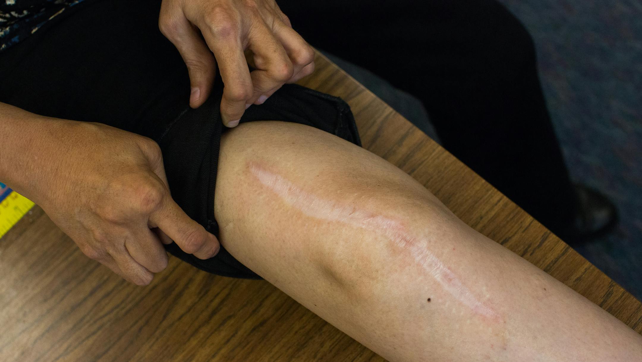 Sylvia Gonzalez shows a scar on one of her knees where she had a knee replacement. Gonzalez suffered from juvenile rheumatoid arthritis and ankylosing spondylitis which locked up her spine. She started getting artificial joints implanted at age 18. She has artificial hips, artificial knees, an artificial ankle, and artificial shoulder. Her spine has been fused so she can‚Äôt turn her head. She has a metal pelvis. With all of that and crippled hands, she teaches second grade at Y