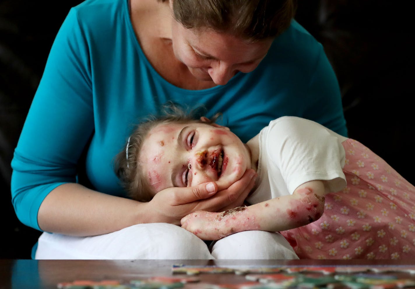 Little Elisa McCann is enrolled and ready to become one of the first pain patients admitted to Minnesota's medical marijuana program. Elisa, now 3, suffers from a horrific genetic condition called epidermolysis bullosa that causes her skin to blister and tear at the slightest contact. She was photographed at home with her mom Gabriella McCann Wednesday, July 27, 2016, in St. Paul, MN. ](DAVID JOLES/STARTRIBUNE)djoles@startribune On Monday, Minnesota's medical marijuana clinics will open their do