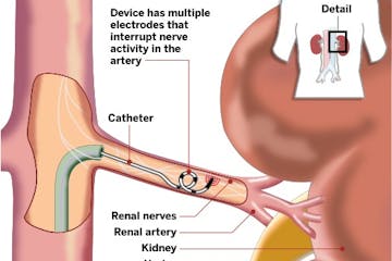 Renal denervation procedure