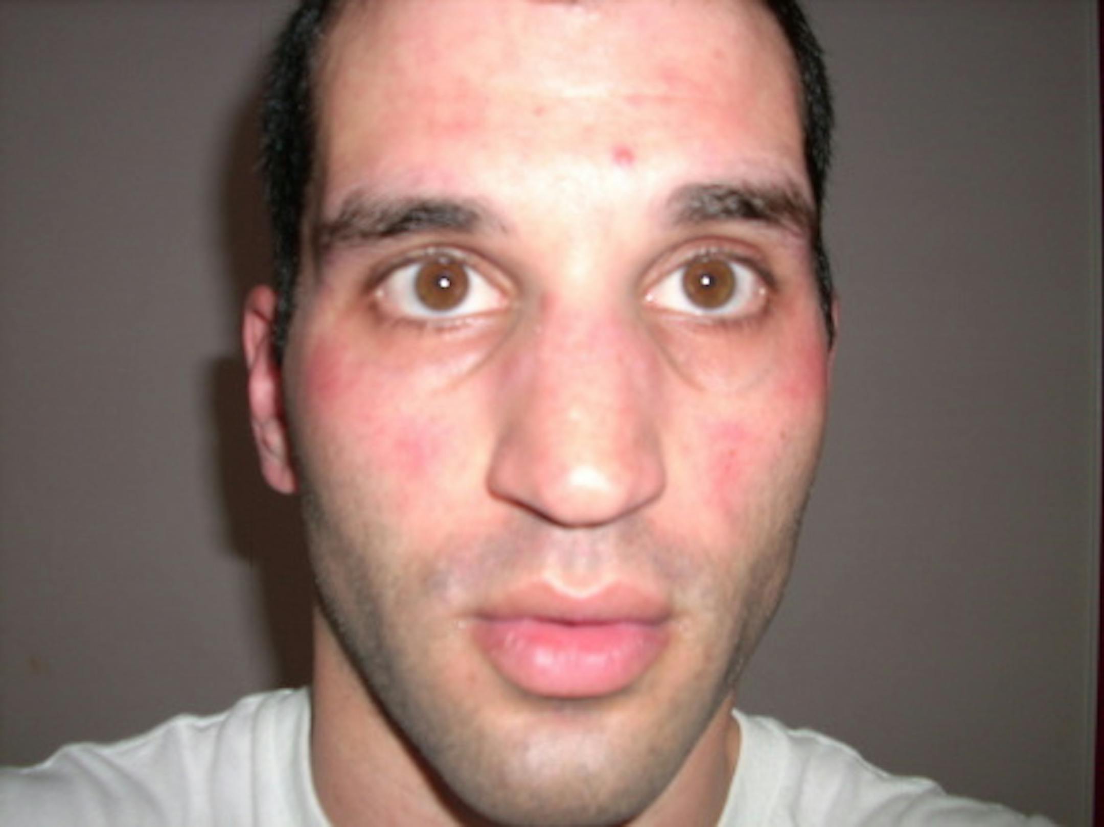 My face after getting tear-gassed