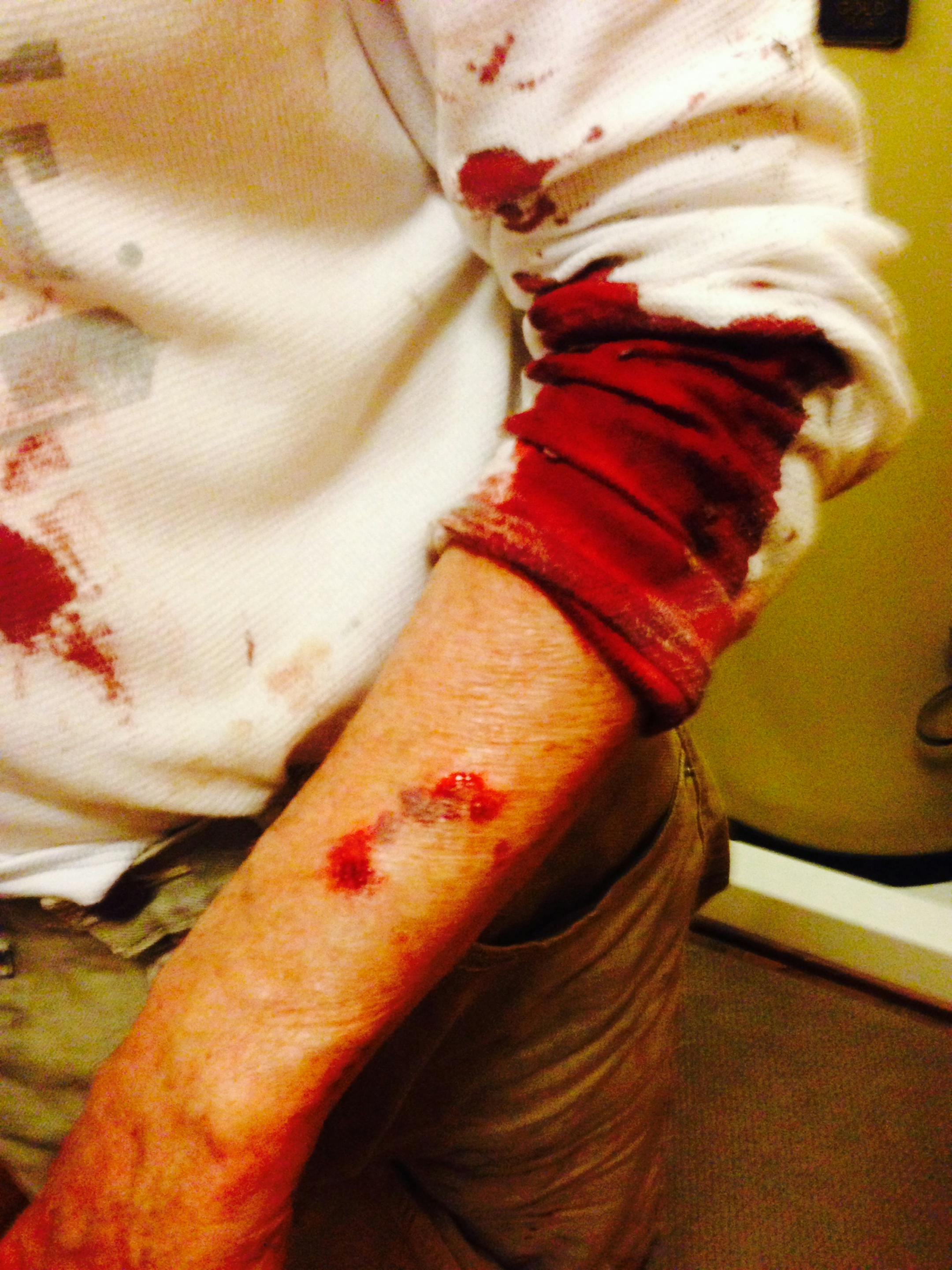 Steve Rösch was bitten as a pitbull-boxer mix attacked and killed a small Papillon Sunday at Martin Luther King Park in south Minneapolis.