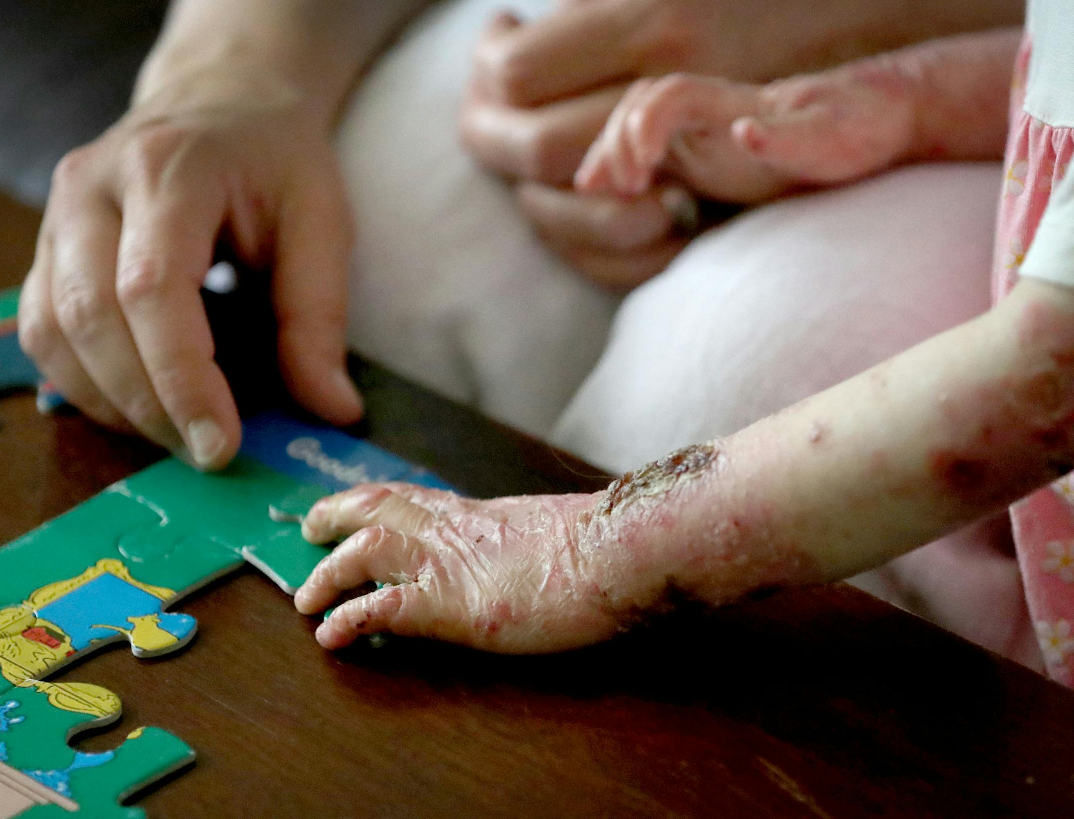 Little Elisa McCann is enrolled and ready to become one of the first pain patients admitted to Minnesota's medical marijuana program. Elisa, now 3, suffers from a horrific genetic condition called epidermolysis bullosa that causes her skin to blister and tear at the slightest contact. She was photographed at home with her mom Gabriella McCann Wednesday, July 27, 2016, in St. Paul, MN. ](DAVID JOLES/STARTRIBUNE)djoles@startribune On Monday, Minnesota's medical marijuana clinics will open their do