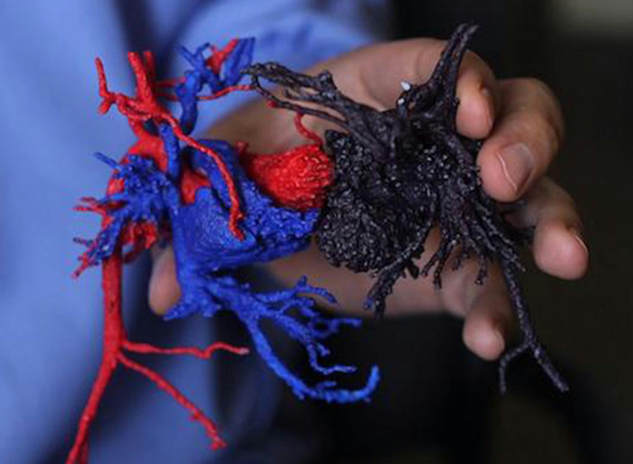 Doctors were given a 3-D model of Paisleigh (red and blue) and Paislyn's (purple) hearts to help them prepare for surgery. MUST CREDIT: Photo courtesy of University of Minnesota