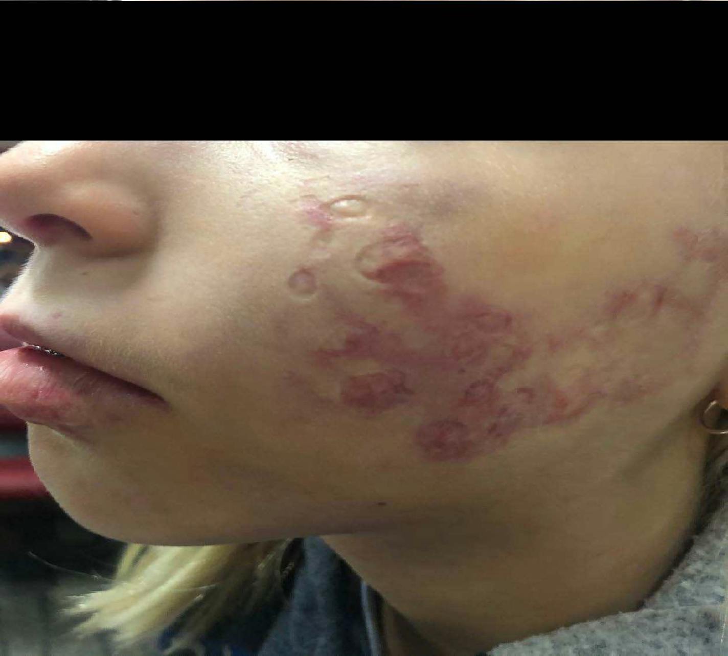 A six-year-old girl was injured in 2017 after receiving improper laser treatment for a port wine stain birthmark on the left side of her face, according to a lawsuit. This photo shows the injuries after they healed and scarred.