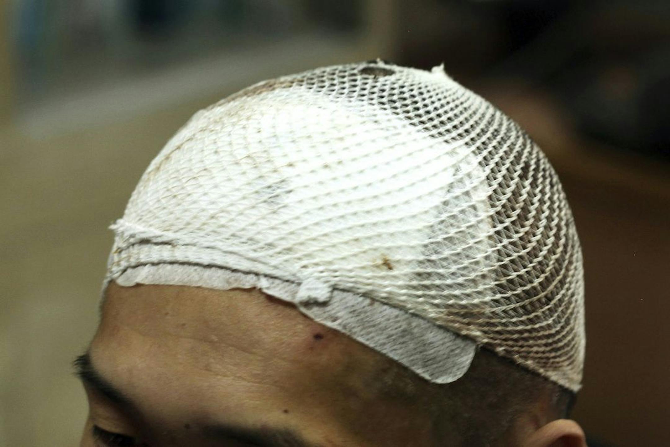 CAPTION ADDITION: REMOVES WORD 'ADDICT' TO ADHERE TO AP STYLE: Bloodied white mesh covers the head of a methamphetamine user named Yan on Monday, Oct. 29, 2018, three days after he had a deep brain stimulation device implanted as part of a clinical trial at Ruijin Hospital in Shanghai, China. The hope is that DBS will extinguish his addiction, quite literally, with the flip of a switch. Critics say such human experiments are premature and risky, but U.S. regulators in February greenlighted a hum