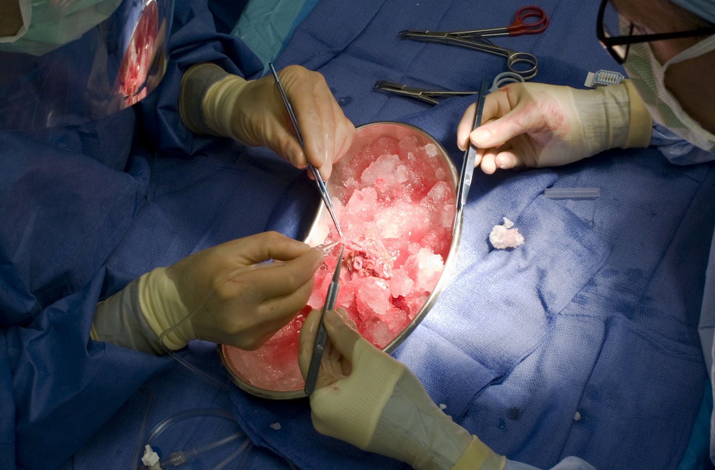 FILE - In this Oct. 4, 2010 file photo, doctors work on a kidney recently removed from a donor at a hospital in Portland, Ore. A study released on Monday, Nov. 9, 2015, finds that wealthy people are more likely to get on multiple waiting lists and score a transplant, and less likely to die while waiting for one. (Torsten Kjellstrand/The Oregonian via AP, File)