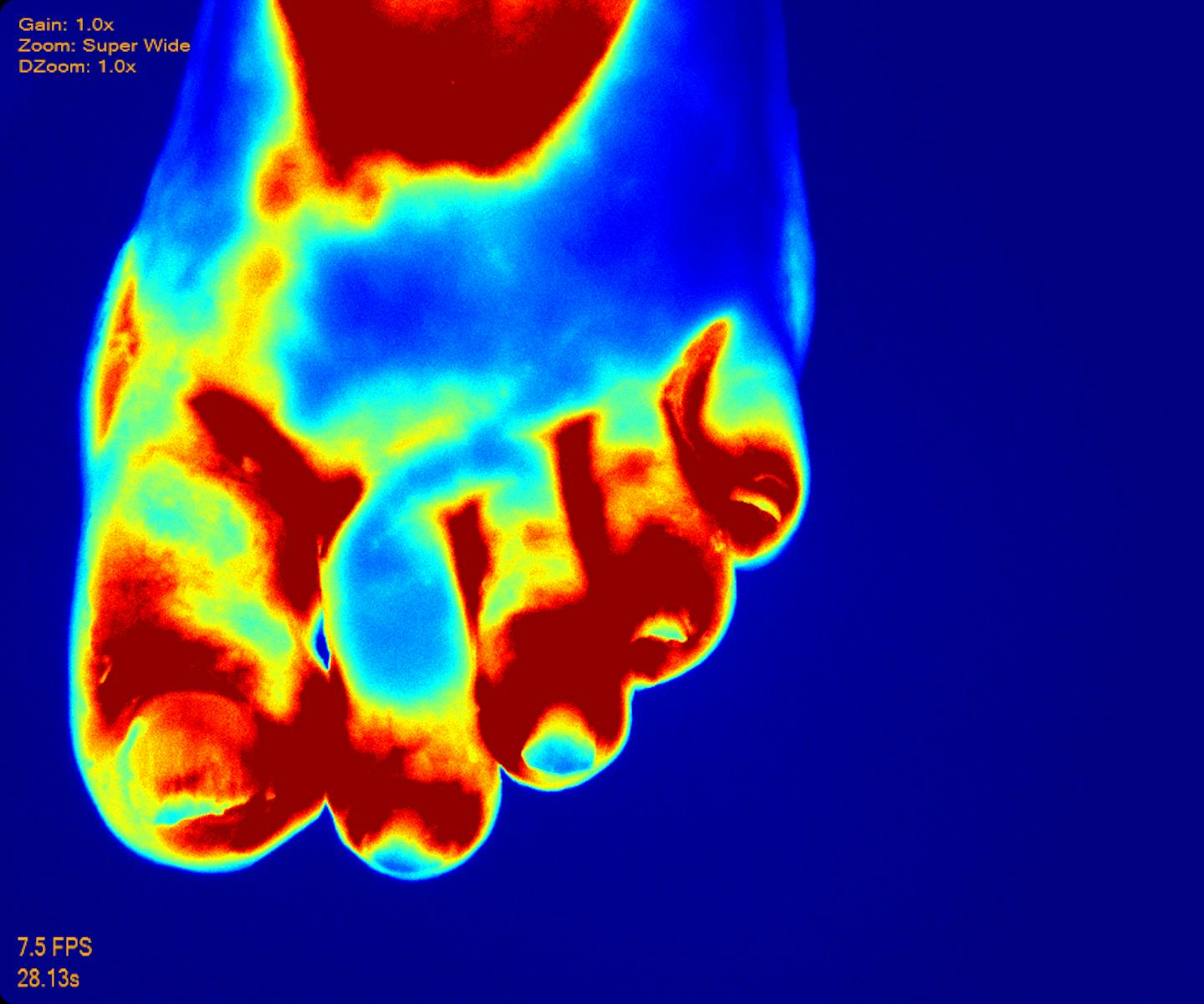 This image from a Luna fluorescence angiography screen at Hennepin County Medical Center shows how circulation has been re-established in a patient&#xed;s foot after five days of hyperbaric treatments. Warm colors depict stronger blood flow. The $250,000 Luna machine is the only one of its kind in the state. Credit: Hennepin County Medical Center