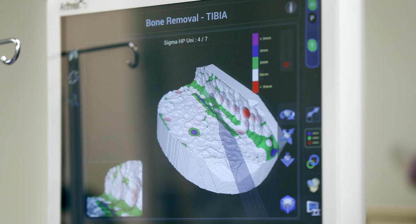 Smith & Nephew&#x2019;s system, the Navio, uses color-coded 3-D images to show how many millimeters of bone the surgeon has to drill out to make room for an artificial knee implant. The robotic system uses precision guidance to monitor how much bone has been removed, and then stops the surgeon&#x2019;s hand-held drill tip when the boundaries of the model are reached.