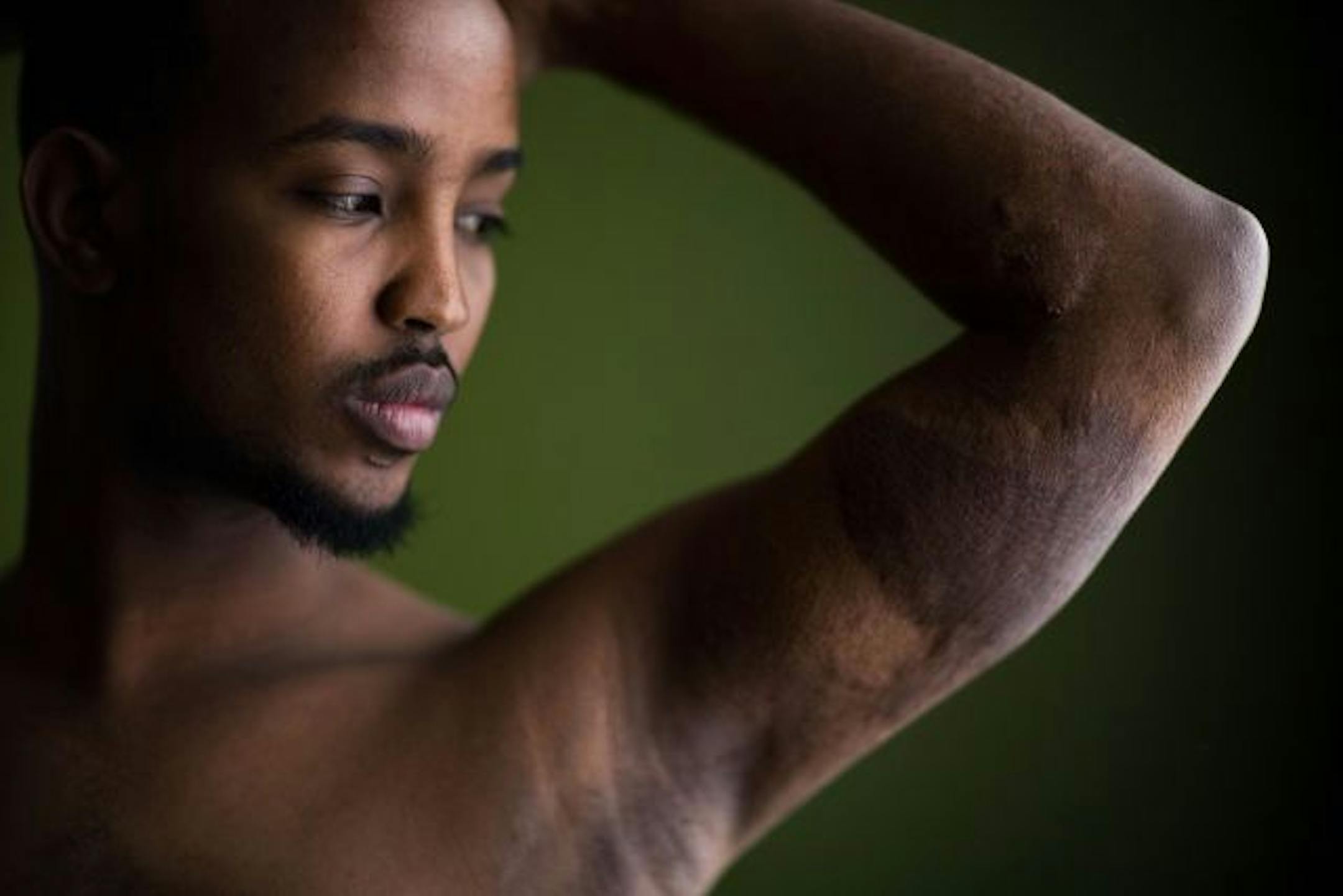 Liban Hussein, 26, now lives in South Sioux City, Neb., where he works at a meat packing plant. Over 40 percent of his body was burned when gunmen stormed into his family's shop in Mogadishu, splashed gas around and set it on fire. His mother and brothers were killed.