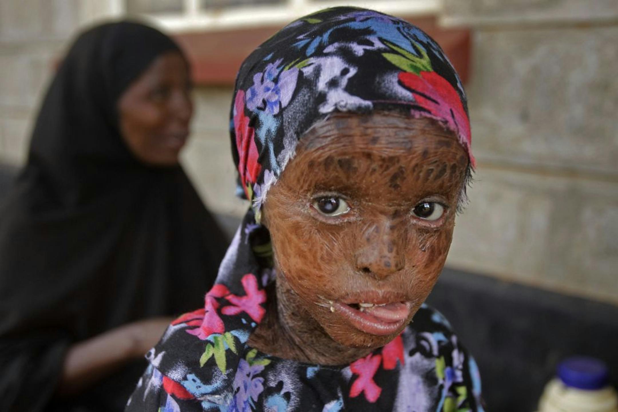 A child with a skin disorder got treatment for malnutrition at a border town in Kenya on Saturday. People who can barely stay on their feet due to hunger walk for days or even weeks through parched wasteland to find a meal and water. Many also set out to seek help for their children. More than 2 million children in Somalia are at risk of starvation.