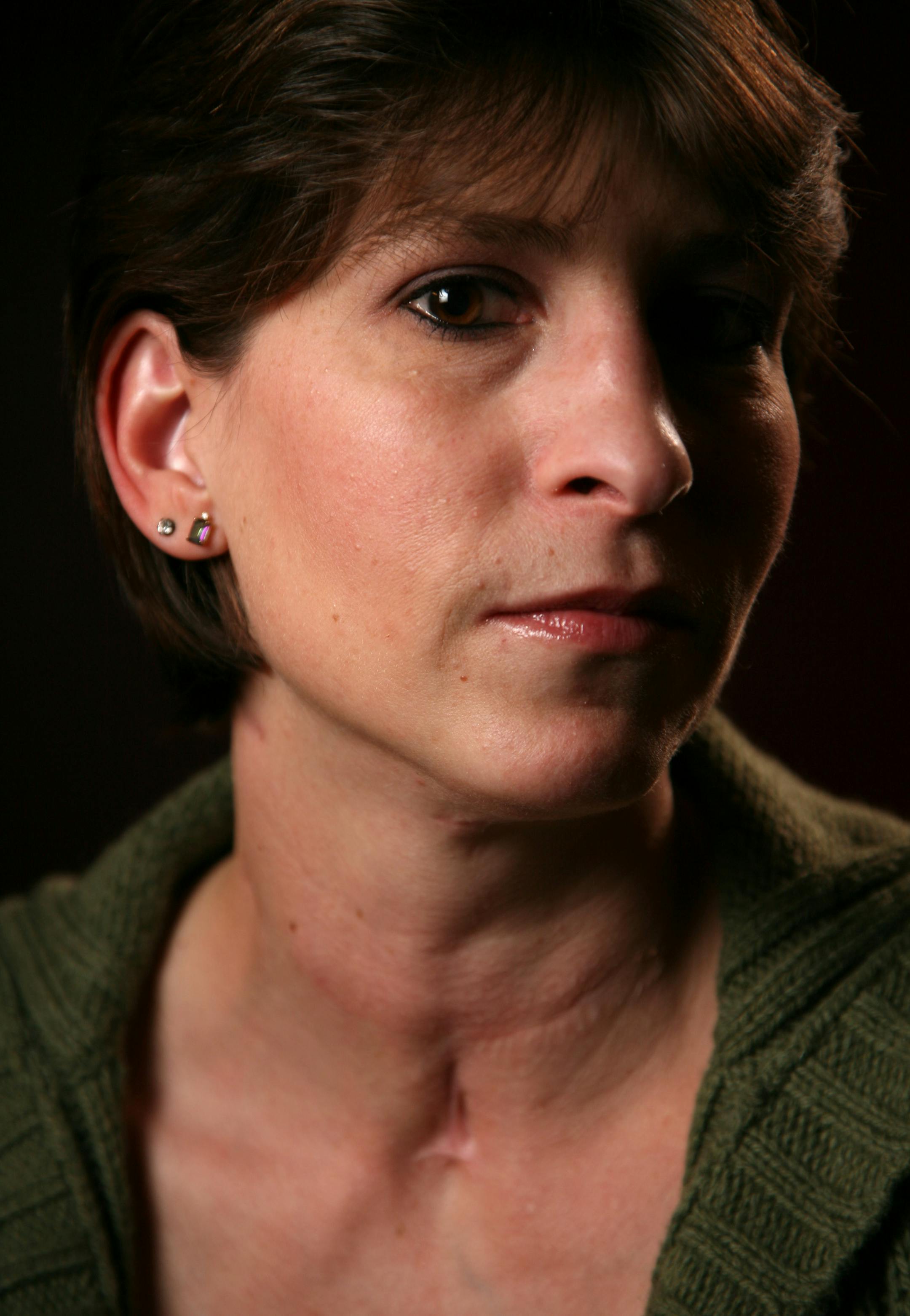 Paula Ybarra still bears scars from an attack by a neighbor's dogs.