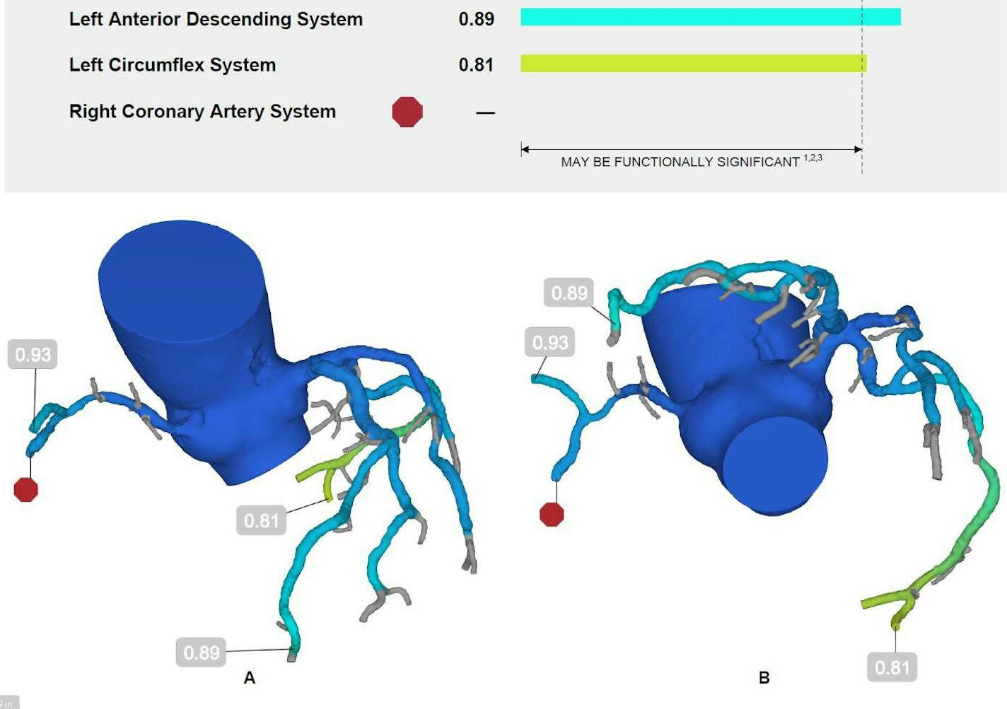 Images of the coronary arteries of Colleen Loye, 77, were fed into the HeartFlow supercomputer in California, which determined that blockages were not causing substantial declines in blood flow. (A fractional flow rate below .8 is considered problematic.) Loye as a result did not need a costly and invasive catheterization test to rule out cardiac problems as causes of labored breathing.