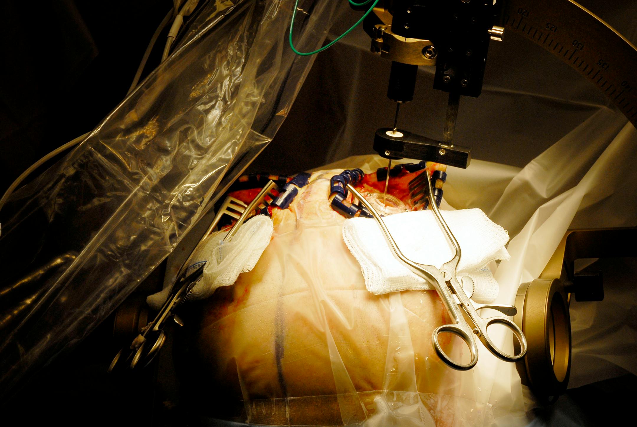 Dr. Richard Veyna performed a deep brain stimulation procedure in 2006 with two holes drilled into Richard Bendix's skull and the implantation of electrodes deep within the brain. A new study gives high marks to the Medtronic procedure that treats Parkinson's disease.