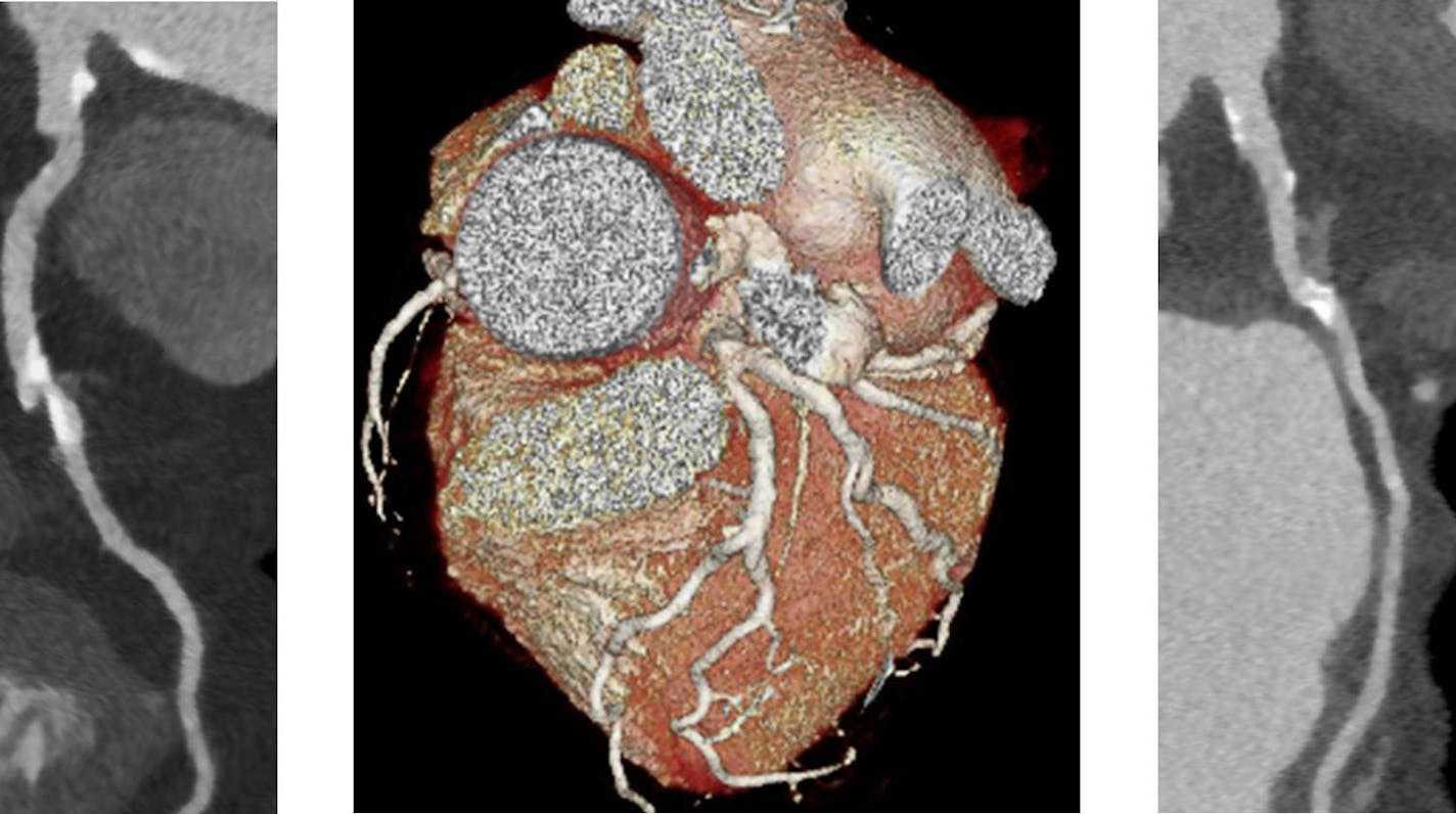 Images of the coronary arteries of Colleen Loye, 77, were fed into the HeartFlow supercomputer in California, which determined that blockages were not causing substantial declines in blood flow. (Blockages show up as white blotches on the scans.) Loye as a result did not need a costly and invasive catheterization test to rule out cardiac problems as causes of labored breathing.