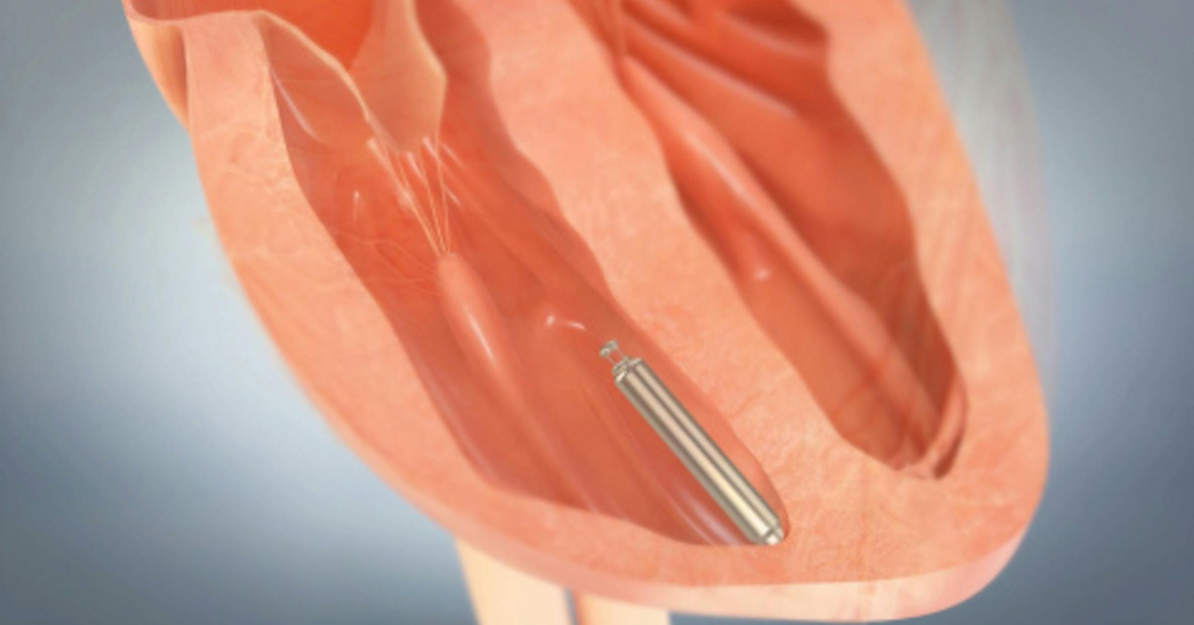 St. Jude starts U.S. test for its tiny pacemaker