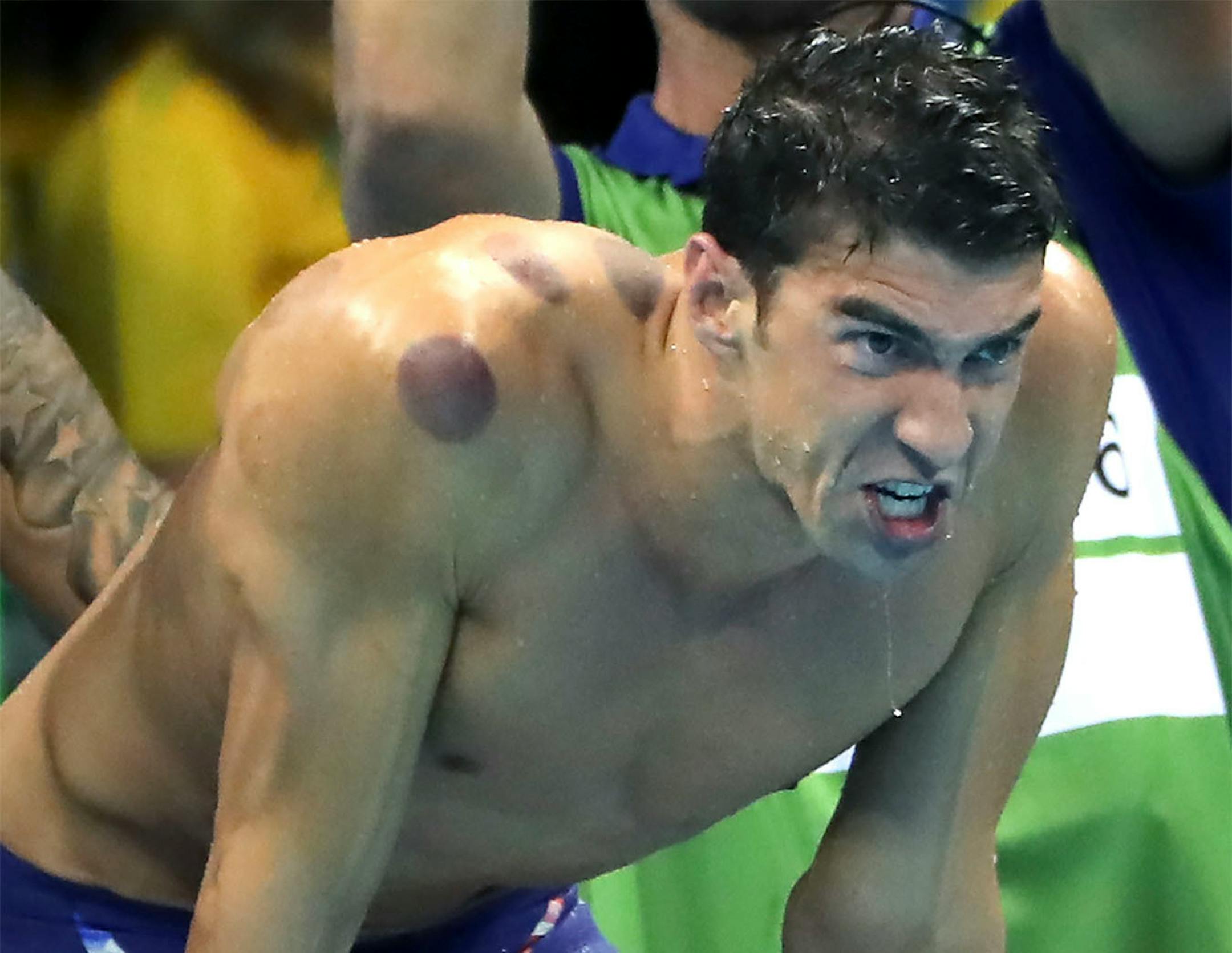 Olympic swimming sensation Michael Phelps is certainly making his mark in Rio, sporting large circular bruises on his body over the weekend. They were the tell-tale signs of a healing technique called �cupping� used by a growing number of athletes to loosen tight muscles and speed up recovery time.