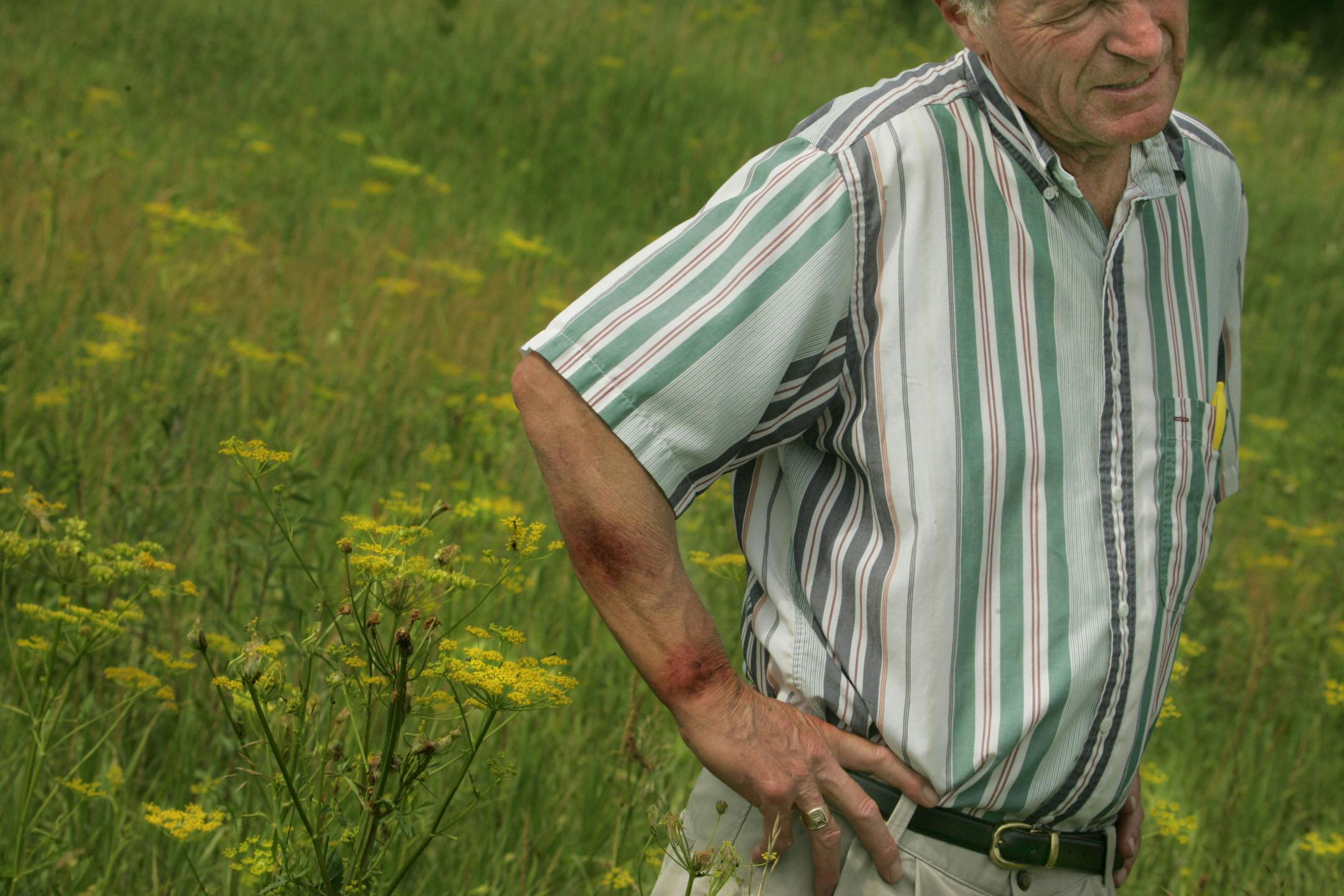 It looks like a harmless wildflower, but wild parsnip spreads quickly and its sap can cause blisters on skin, pictured above. The plant is often found along transportation routes.