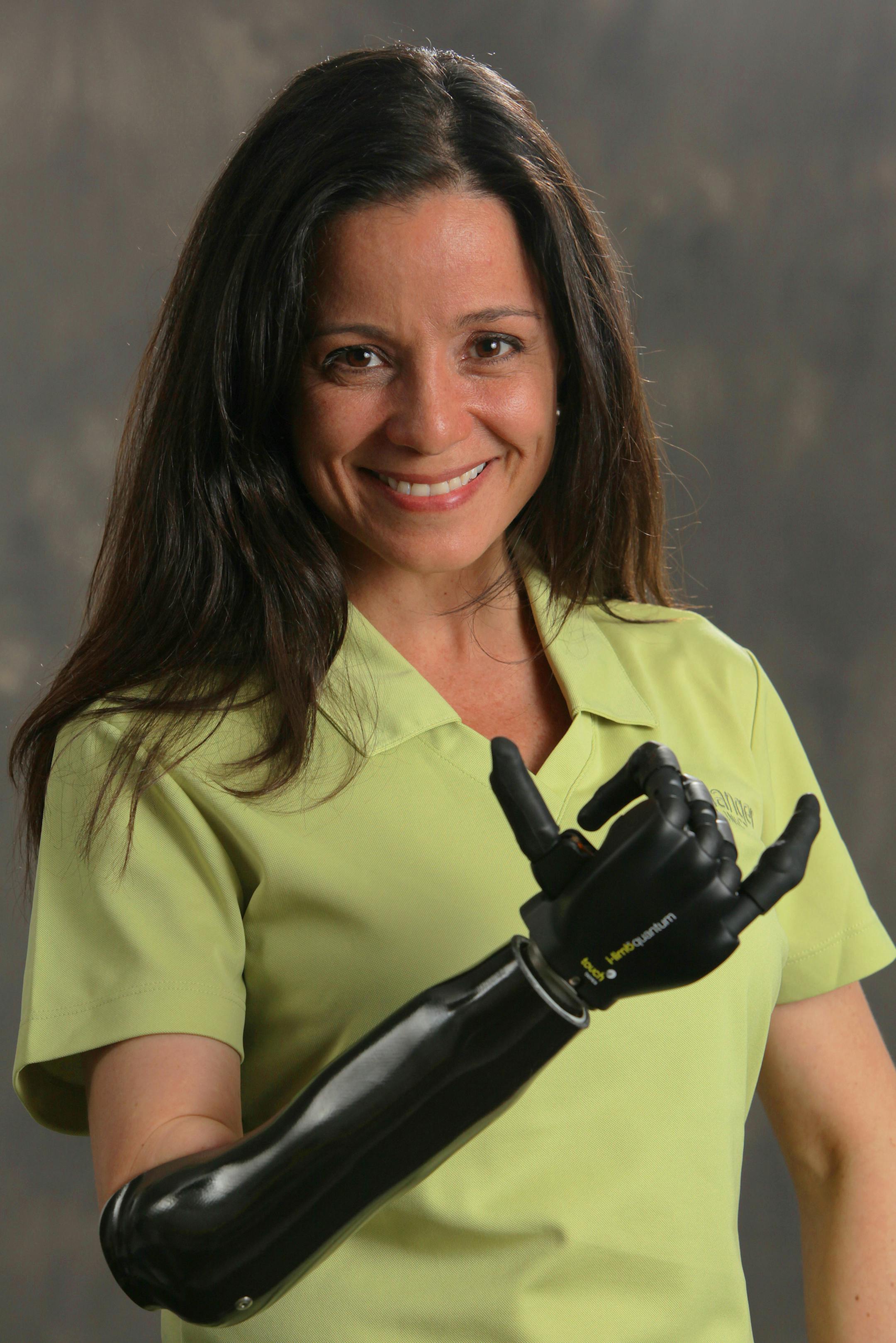 Lizbeth Uzcategui of Fort Lauderdale, Fla., has been training with an i-limb quantum prosthesis, which has five fully functional fingers that make it easier for her to use a mouse on her computer, grab bottles and drive. Uzcategui was born without the right arm below her elbow and three fingers on her left hand. (Photo courtesy Hanger Clinic/TNS)