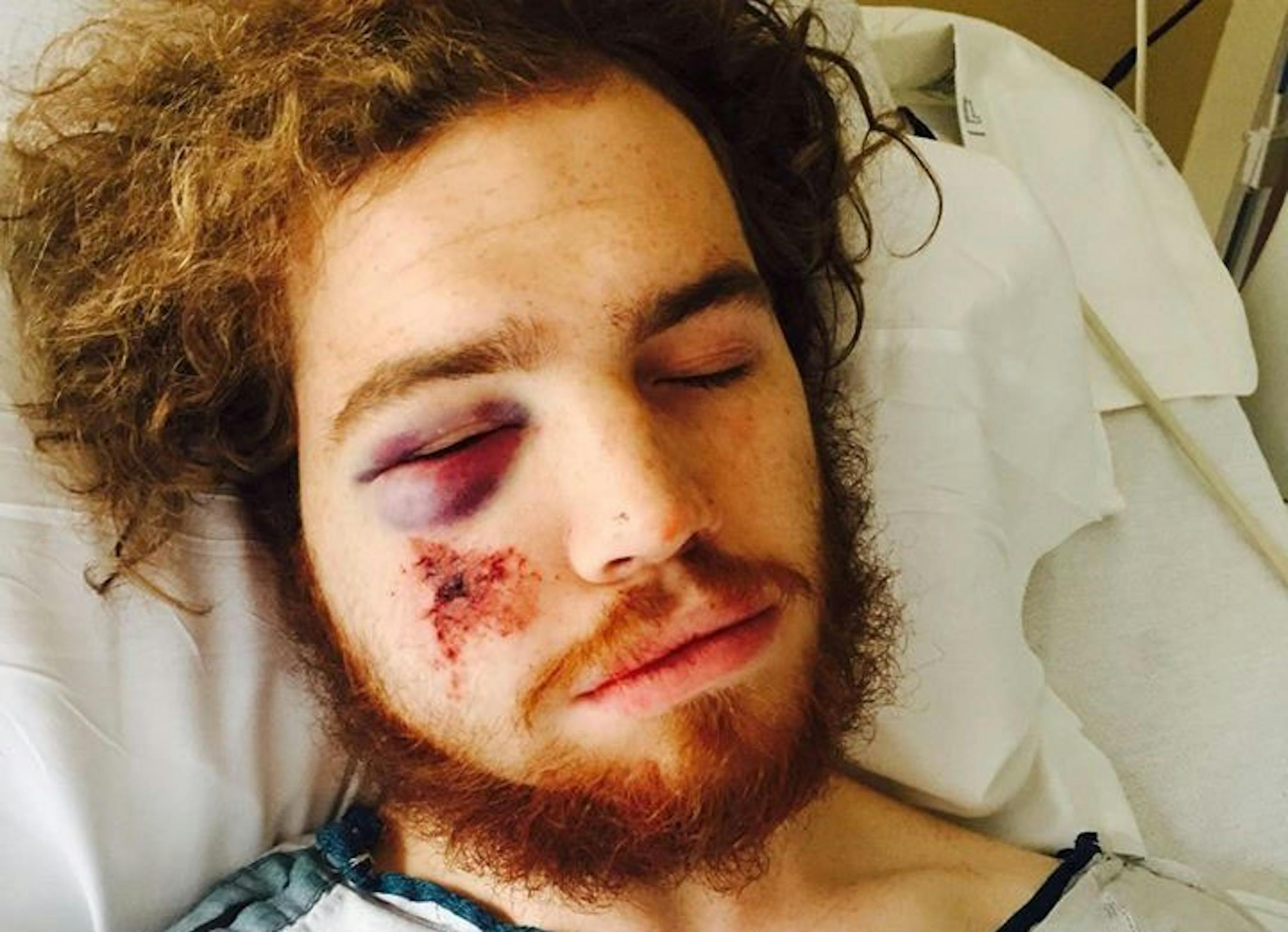 Mackenzie Jensen was struck in the face with concrete and suffered multiple facial fractures that will require two surgeries.