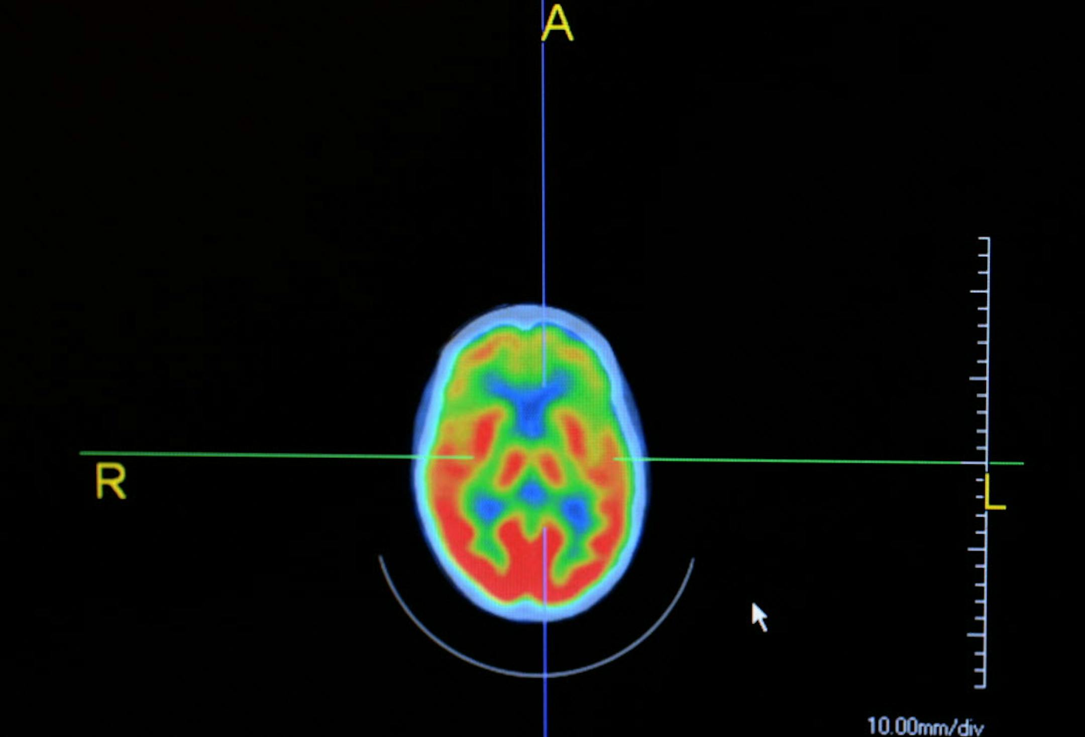 Some 1,300 people will head to the Rivercentre in St. Paul next Saturday to learn more about the millions of people suffering from dementia and Alzheimer's disease -- but the keynote address will be delivered on what some call "the most common disease no one has ever heard of," a brain wasting disease that typically strikes people in their prime. Dr. Michael Rosenbloom health partners neurologist looked over a PET scan of a patient suffering from frontotemporal dementia. ] Richard.Sennott@startr