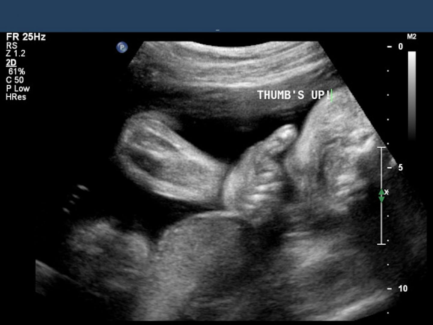 Our 'thumbs-up' baby - ultrasound tech even had to type it on the picture