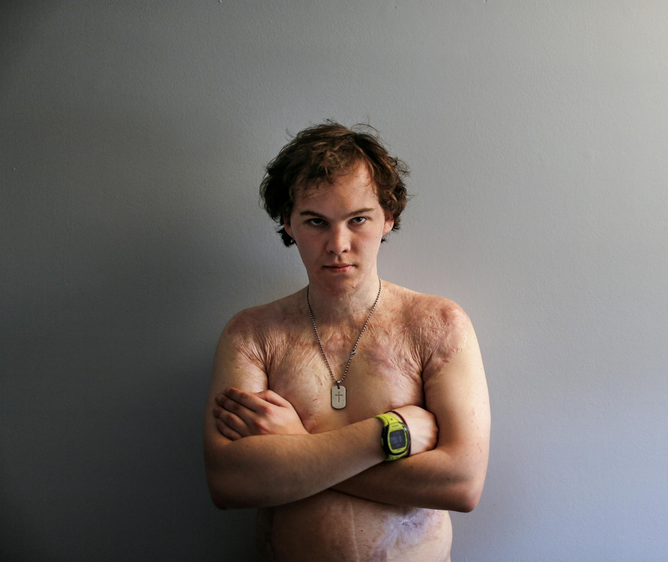 Aidan Spillane, who was diagnosed with schizophrenia at age 18, set himself on fire with gasoline during a psychotic episode two years ago, and still has burn scars covering 40 percent of his body. "These are my tattoos," he said, brandishing them. "I'm healing now."