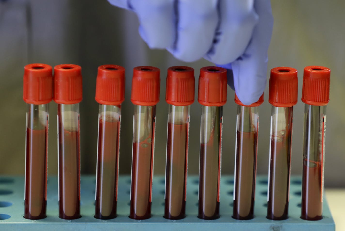 Blood samples from volunteers are handled in the laboratory at Imperial College in London, Thursday, July 30, 2020. Imperial College is working on the development of a COVID-19 vaccine. Scientists at Imperial College London say they are immunizing hundreds of people with an experimental coronavirus vaccine in an early trial after seeing no worrying safety problems in those vaccinated so far. Dr. Robin Shattock told the Associated Press that he and colleagues had just finished a very slow and ard