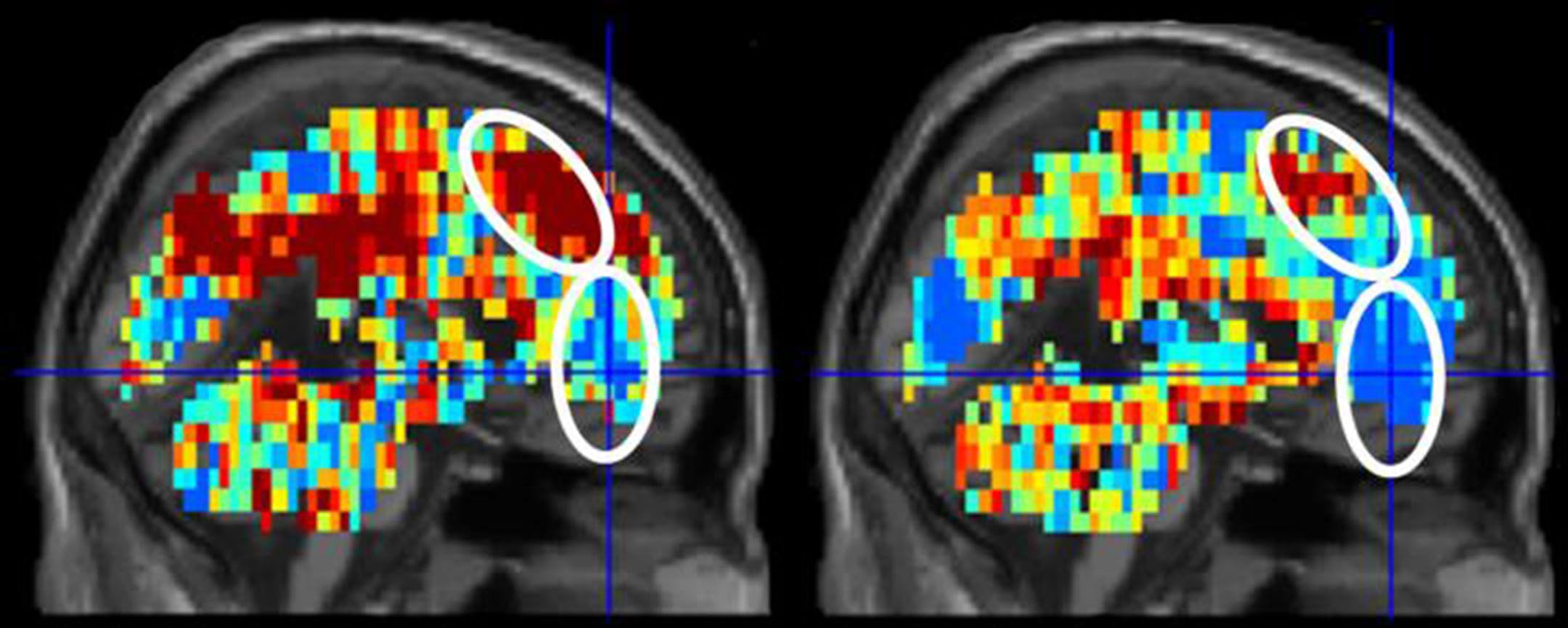 The brain scan related to the word "death" in participants who had made a suicide attempt (left) shows greater activation in areas associated with thoughts of self than the scan for control participants (right). (Carnegie Mellon University)