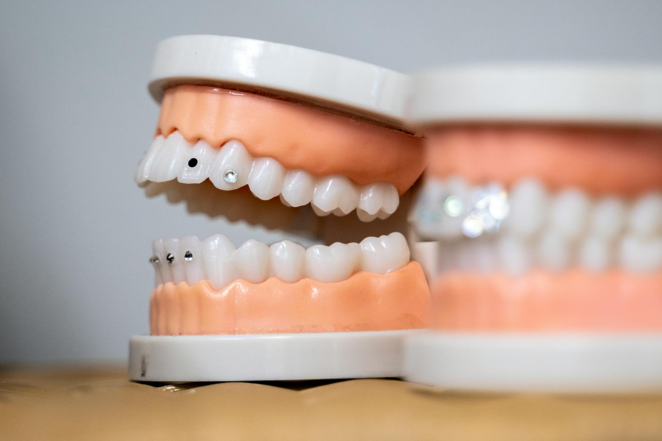 Dental teeth models in Lovo's office display different tooth gem design options in Burnsville, Minn. on Thursday, June 29, 2023.