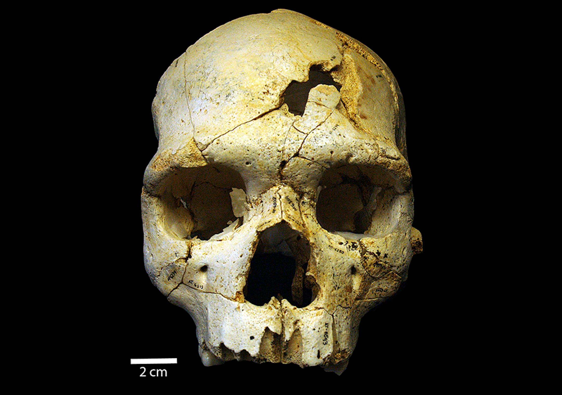 This is the frontal view of Cranium 17, a 500,000 skull that was discovered in a mass grave in Spain. Scientists say is may show the world's oldest recorded murder. The skull has two lethal injuries that were likely caused by another human. Illustrates SKULL (category a), by Sarah Kaplan © 2015, The Washington Post. Moved Thursday, May 28, 2015. (MUST CREDIT: PLOS One)